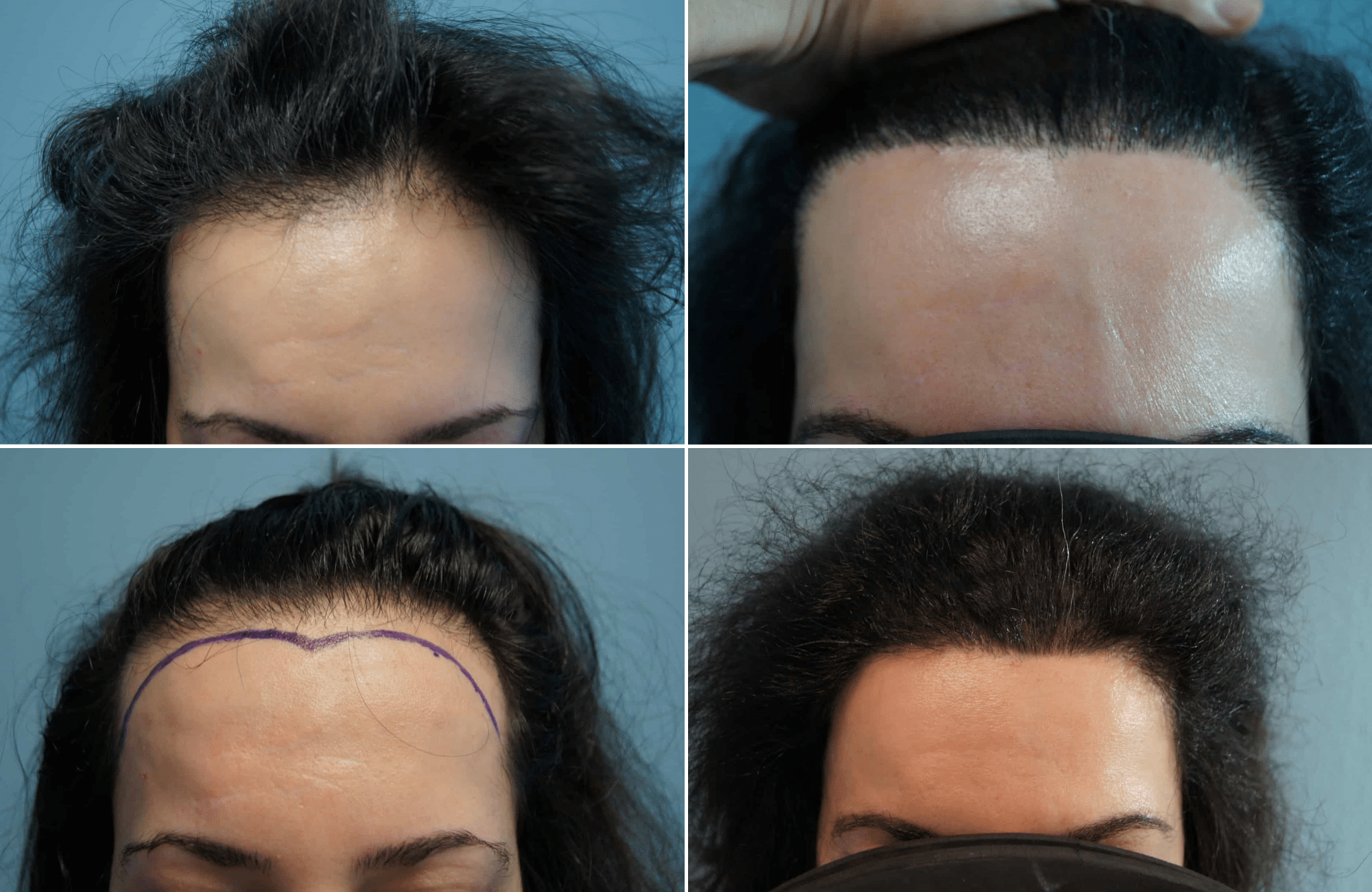 https://anastasakishairclinic.com/portfolio/apotelesma-metamosxefsis-mallion-anastasakis-hair-clinic-268/