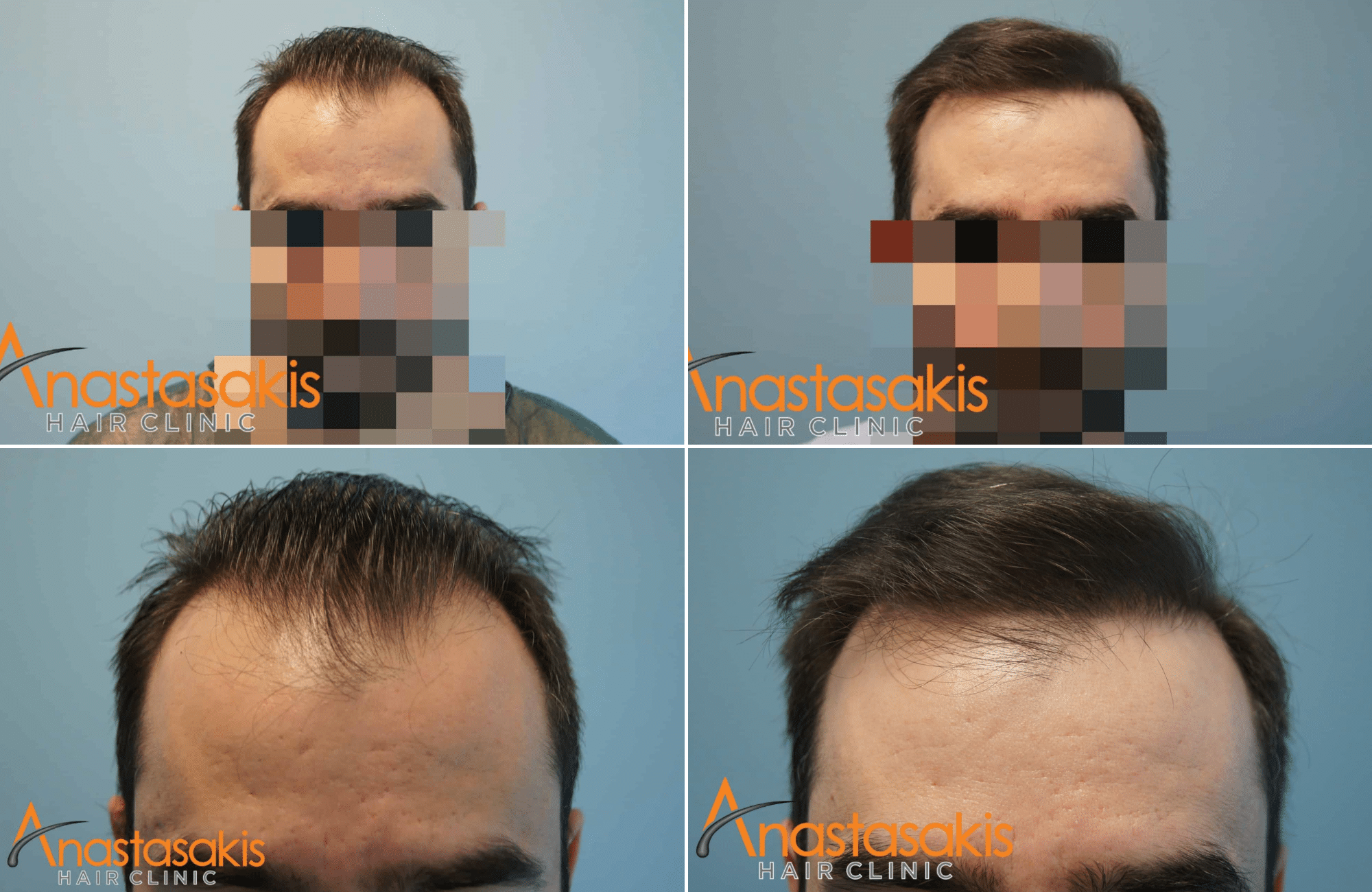 https://anastasakishairclinic.com/portfolio/anastasakishairclinic-result-2500fus-fut/