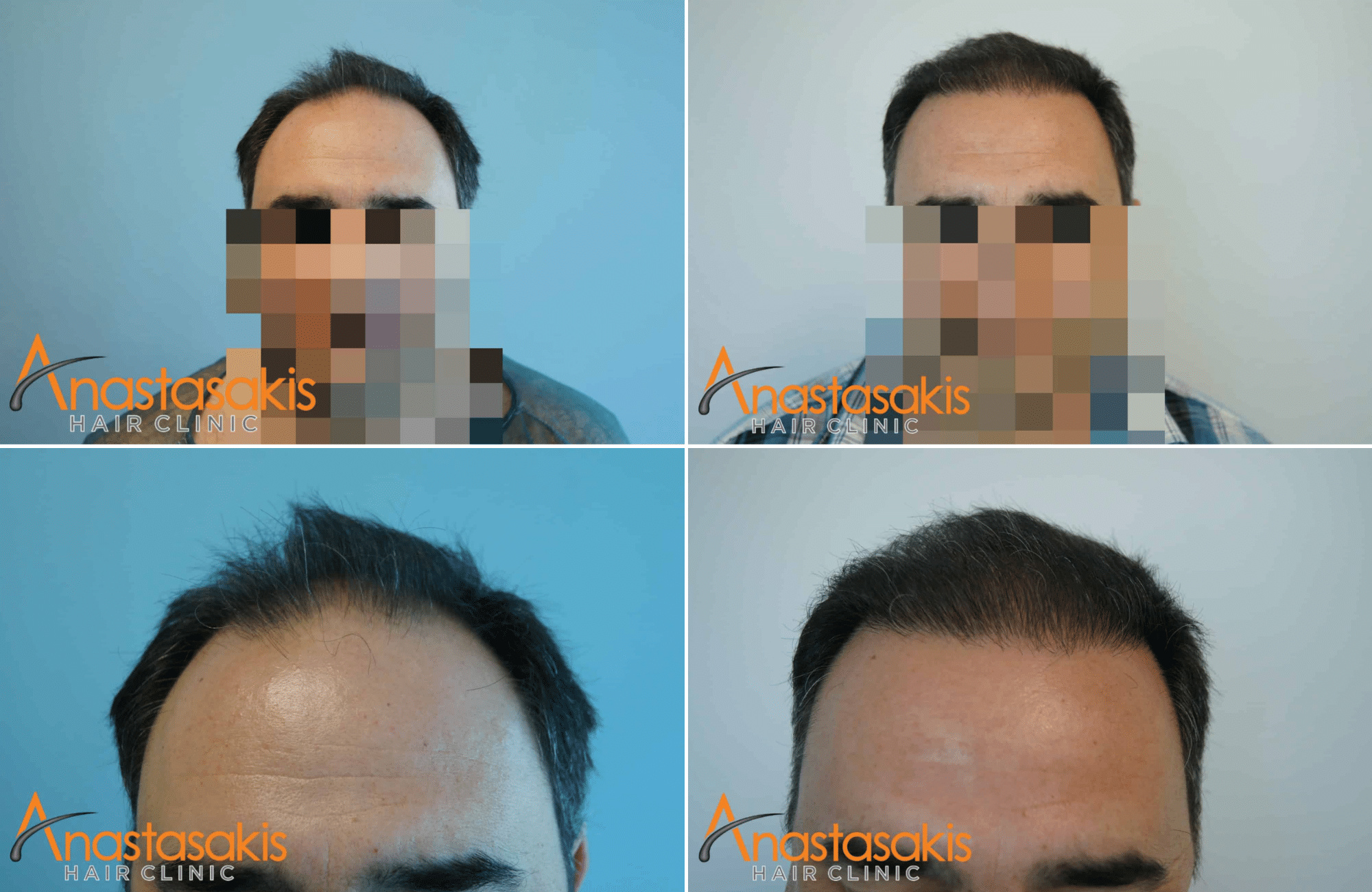 https://anastasakishairclinic.com/portfolio/apotelesma-me-fut-3000-fus-2/