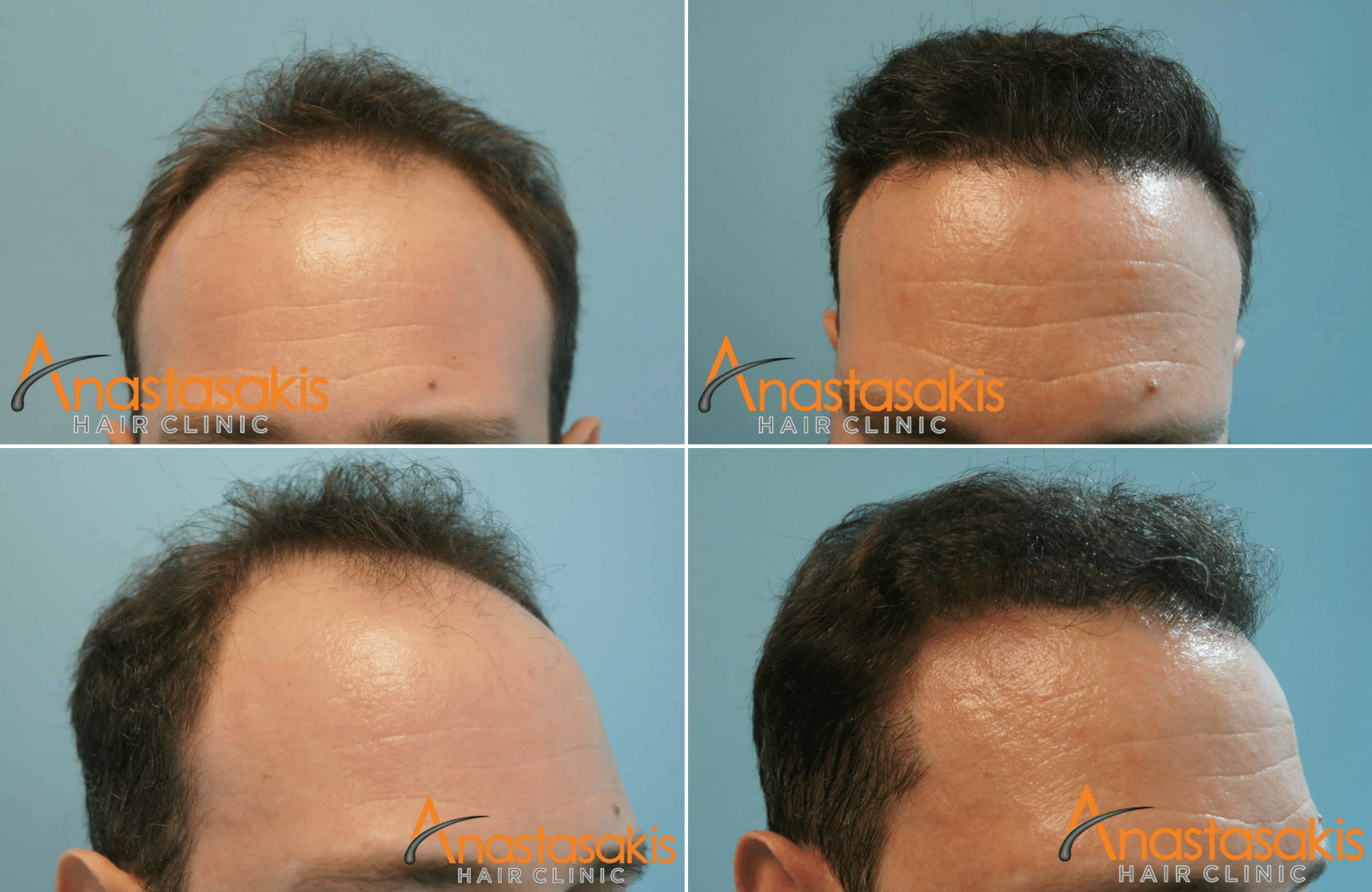 https://anastasakishairclinic.com/portfolio/apotelesma-me-3000-fus-fut-anastasakishairclinic/