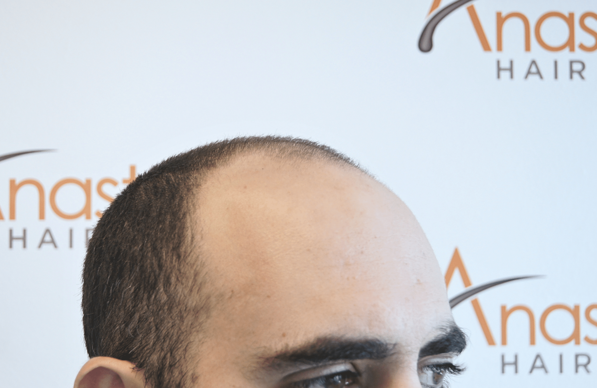 hair transplant result