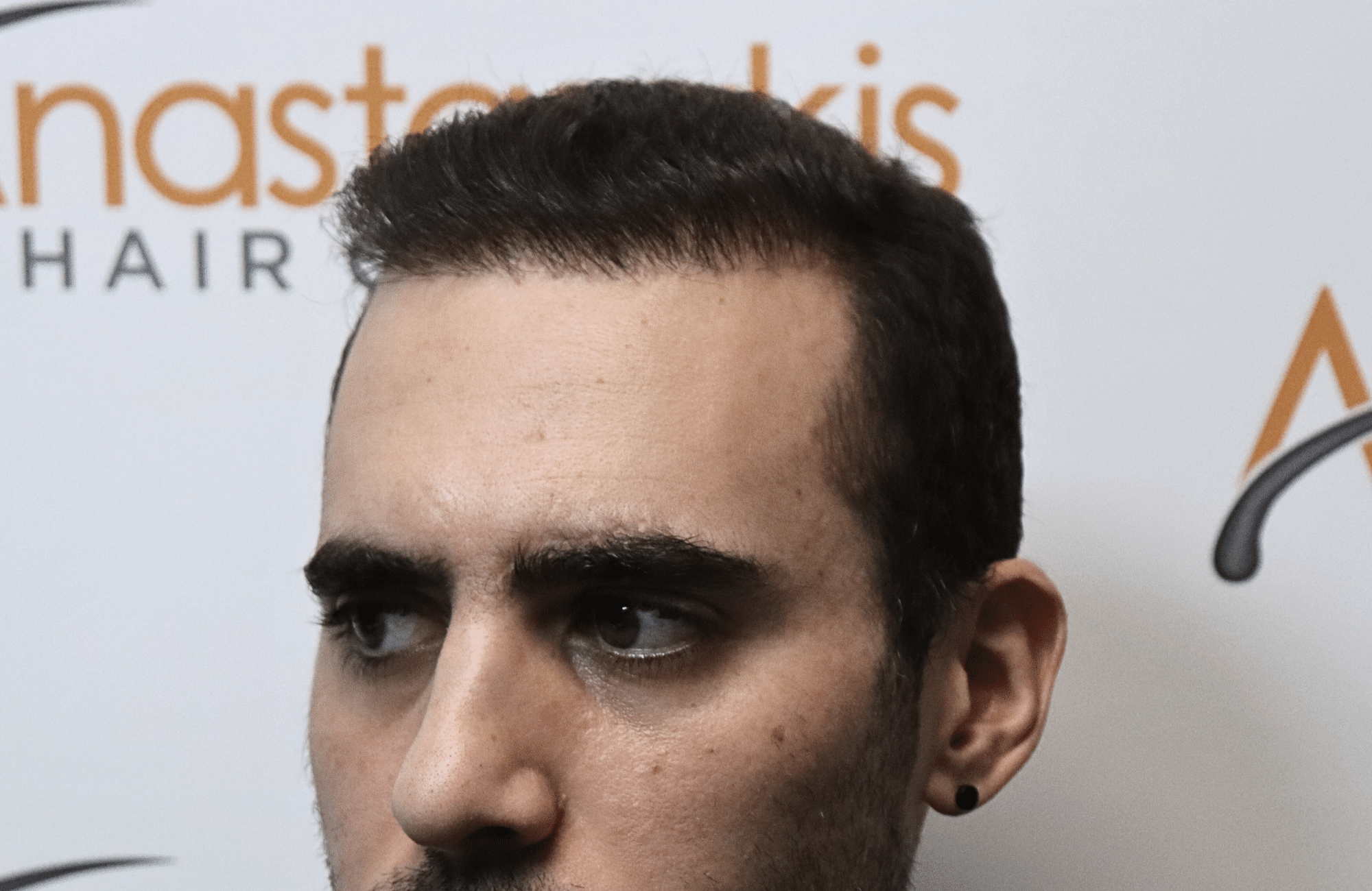 hair transplant result