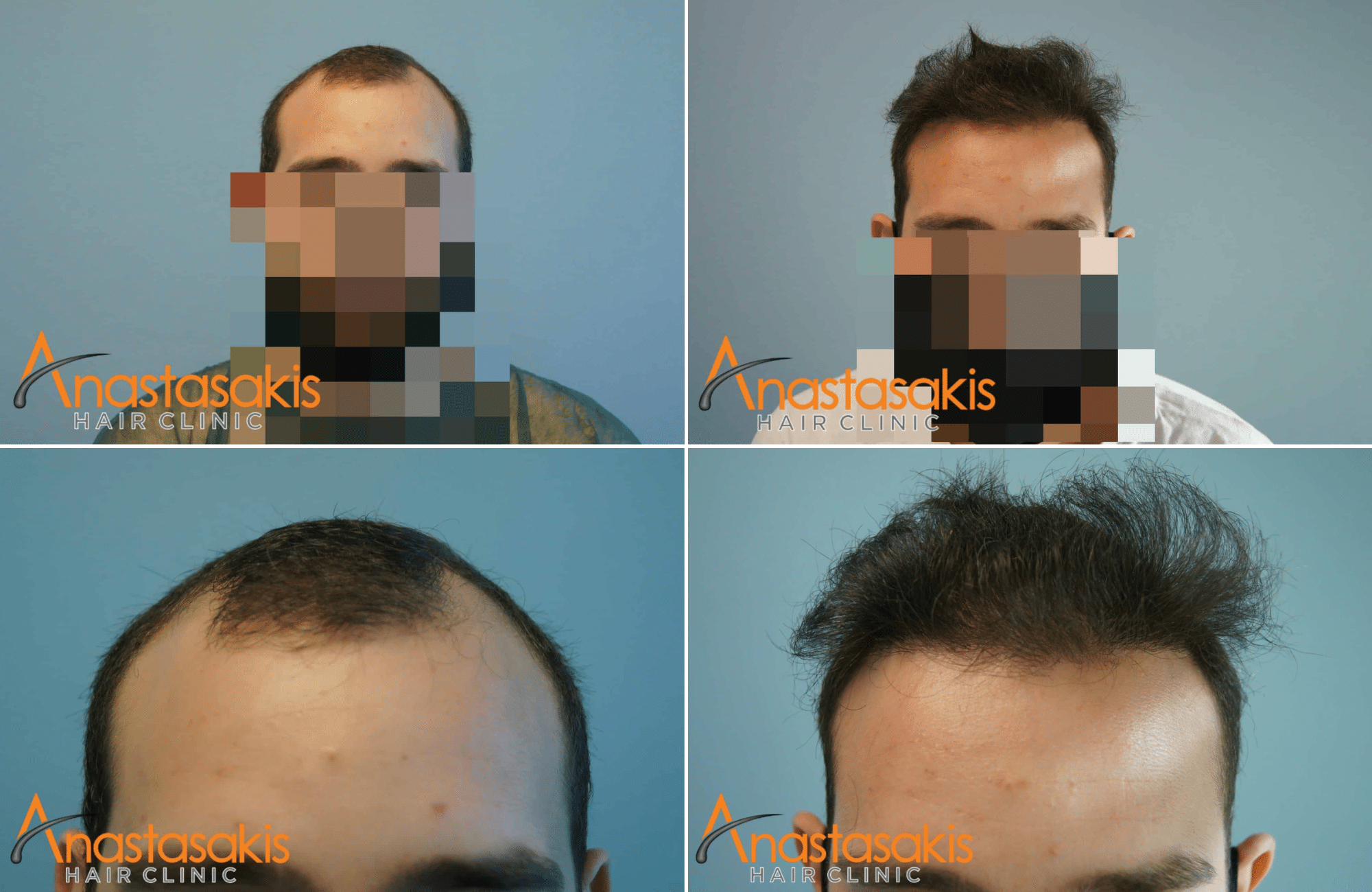 https://anastasakishairclinic.com/portfolio/apotelesma-me-1500fus-fue-anastasakishairclinic/