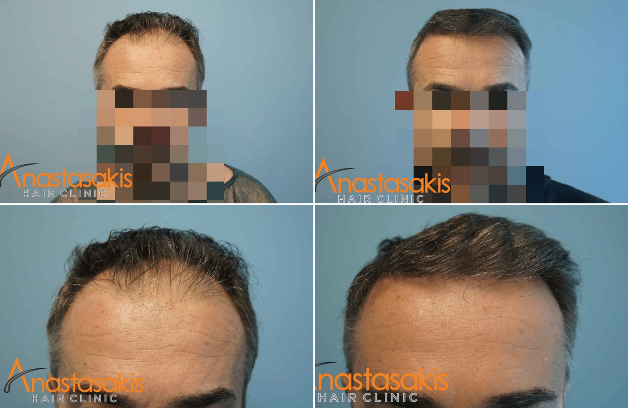 https://anastasakishairclinic.com/portfolio/apotelesma-me-2153-fus/