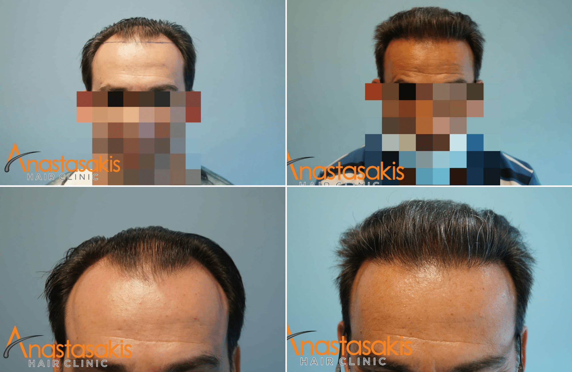 https://anastasakishairclinic.com/portfolio/3500-fus-anastasakis-hair-clinic-result-12months/