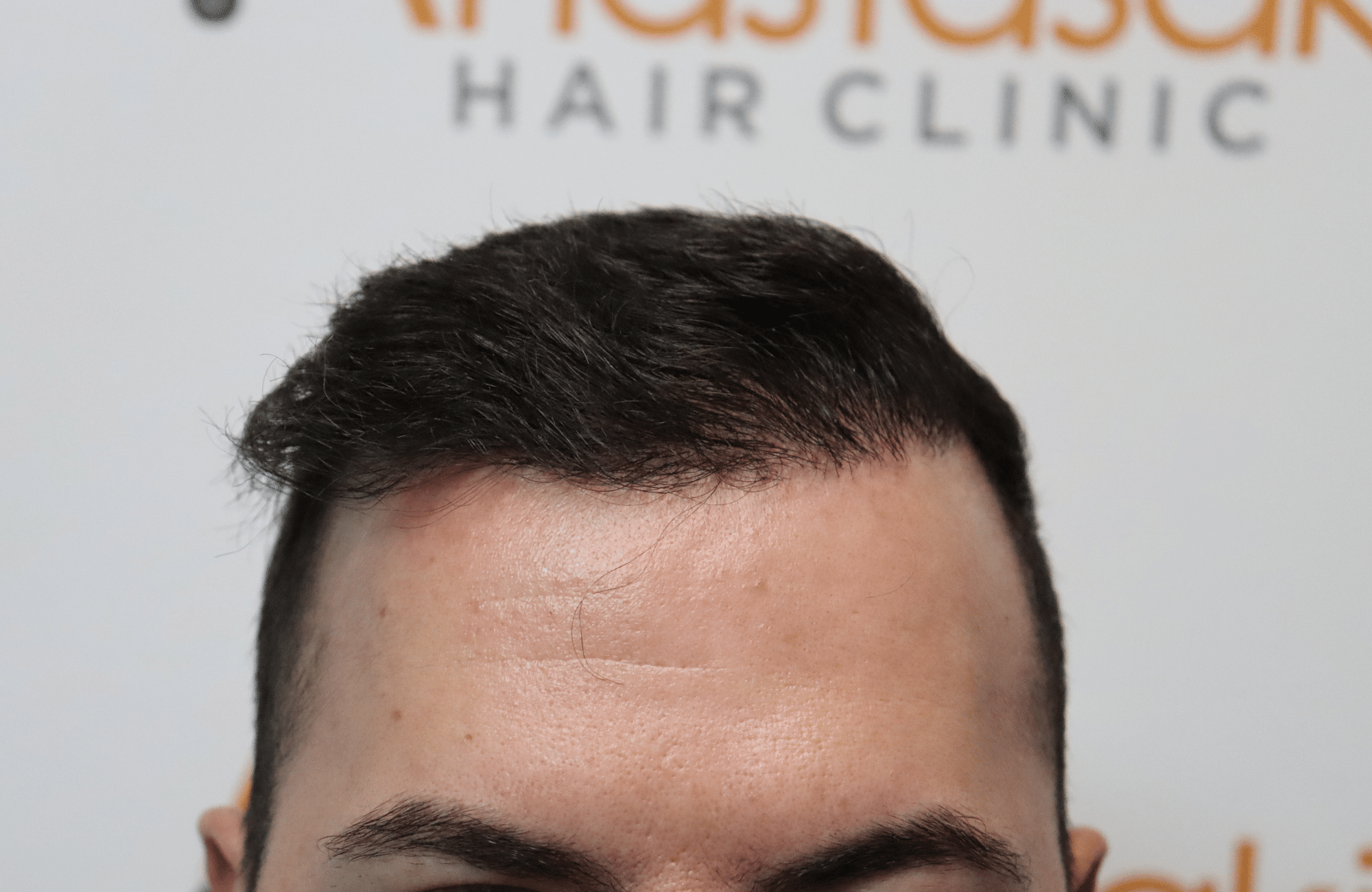 hair transplant result