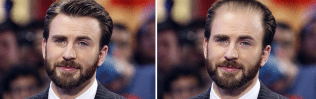 Celebrities χωρίς μαλλιά: Chris Evans