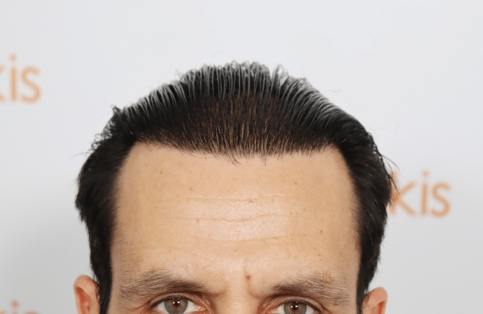 hair transplant result with 4800 follicular units by dr konstantinos anastassakis - hairline after wet hair
