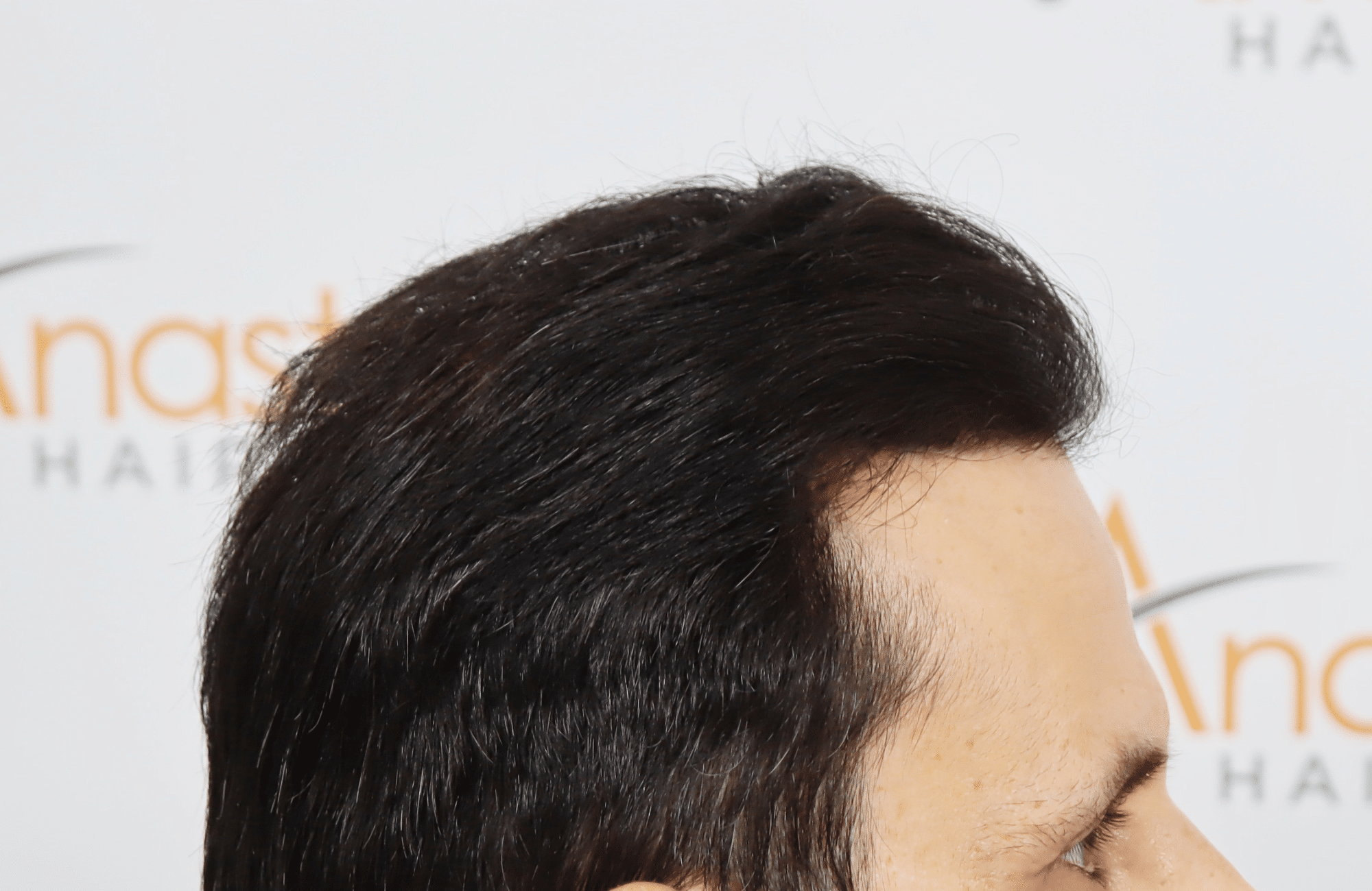 hair transplant result with 4800 follicular units by dr konstantinos anastassakis - side2 after