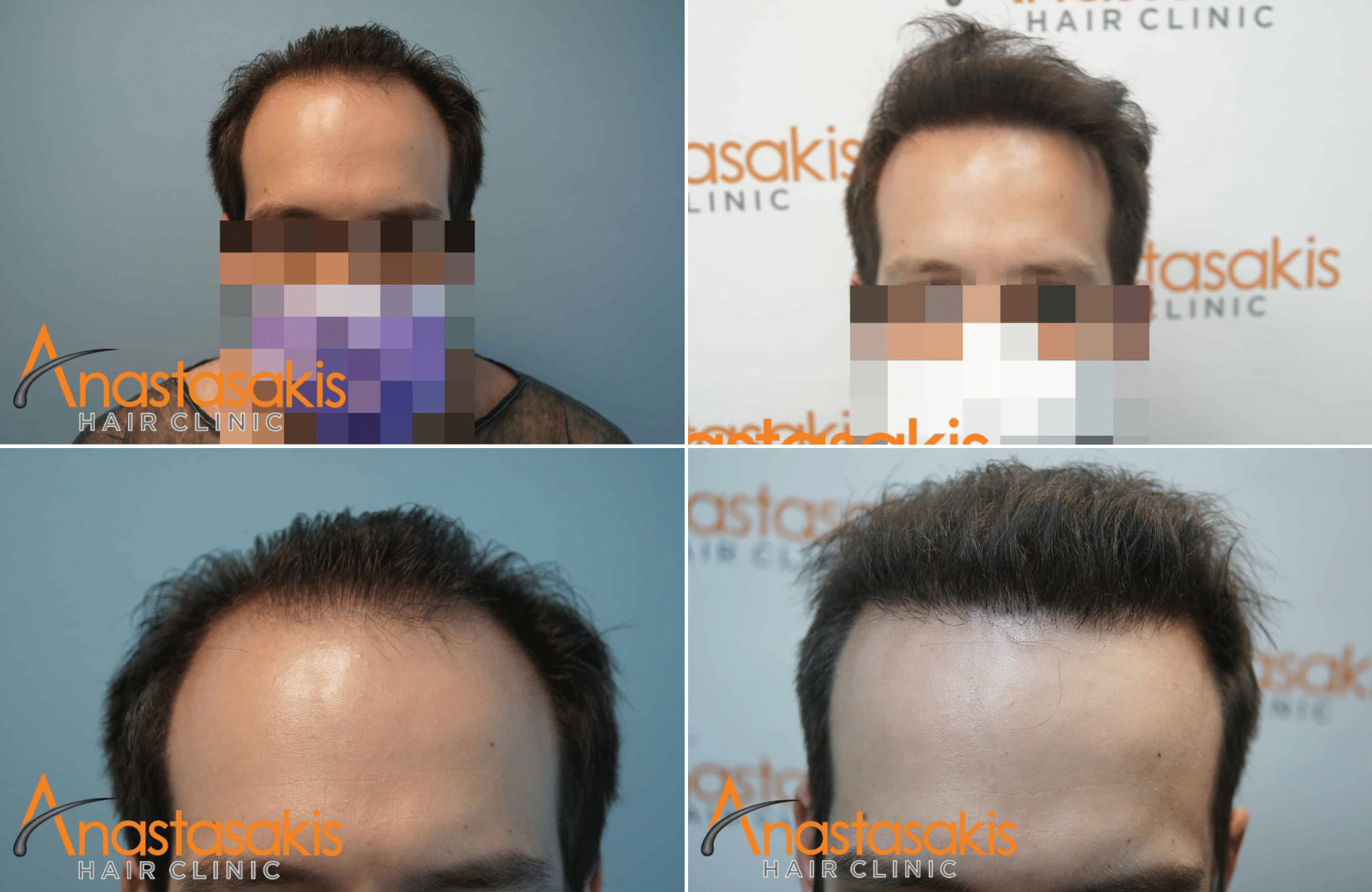 https://anastasakishairclinic.com/portfolio/apotelesma-7-mines-met-ti-metamosxefsi-mallion-2500fus/