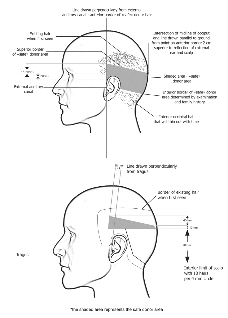 pictures of the safe donor area in both fue and fut