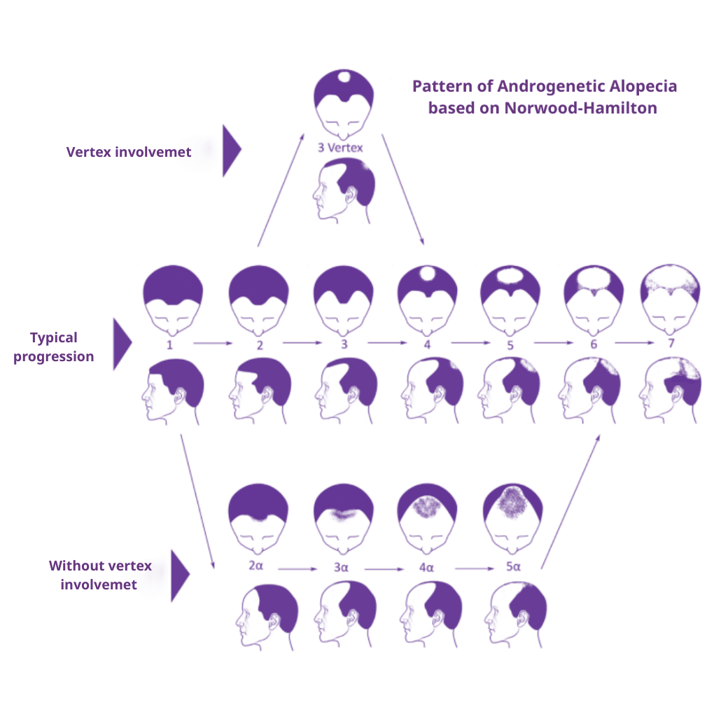 Androgenetic Alopecia