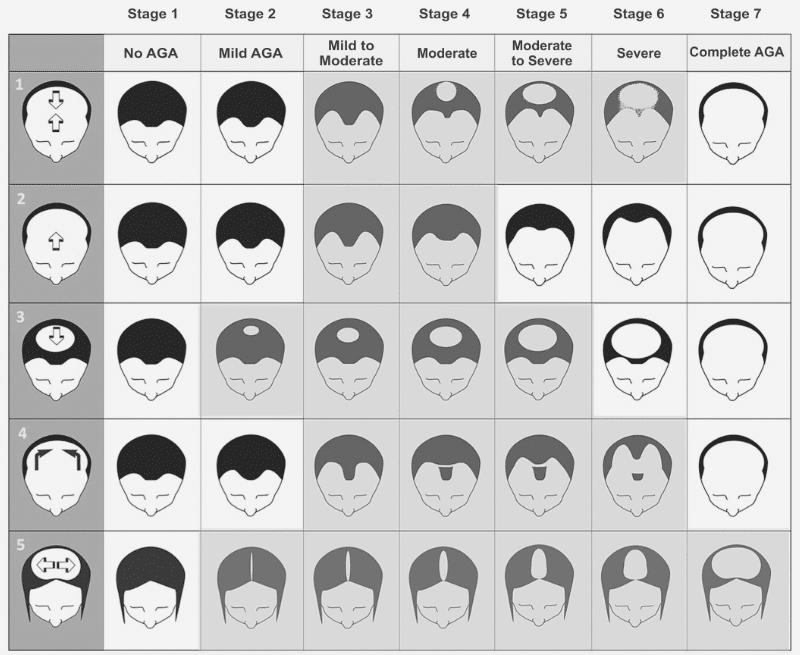 Hair transplantation using FUE and FUT techniques – stages of hair loss (alopecia)