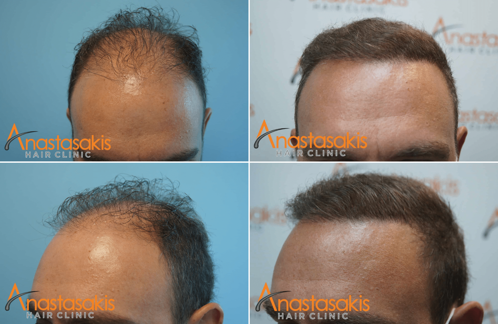 https://anastasakishairclinic.com/portfolio/peristatiko-me-2500-fus-me-tin-texniki-fut/