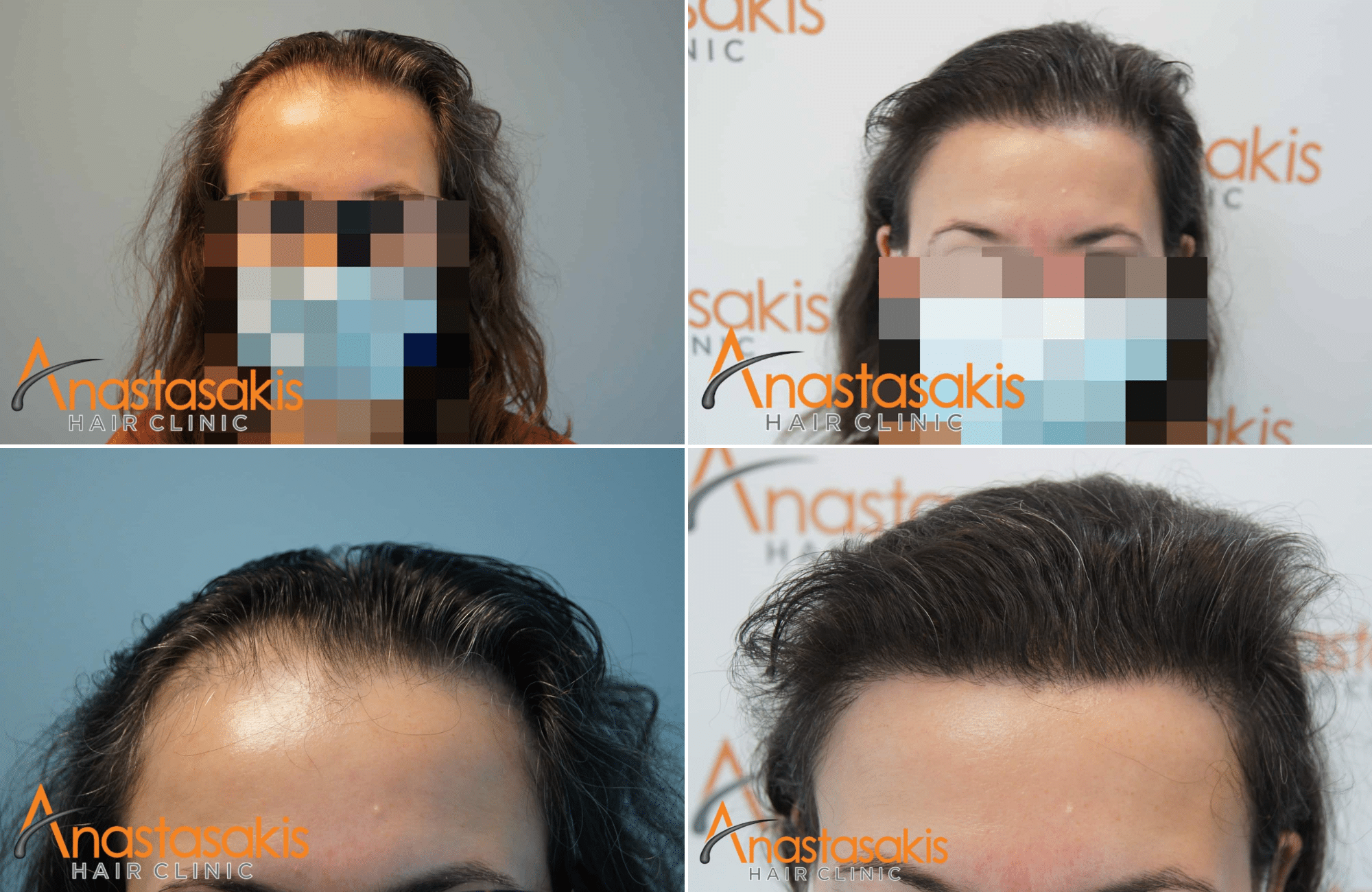 https://anastasakishairclinic.com/portfolio/woman-hair-transplant-2600-fus-with-fut/