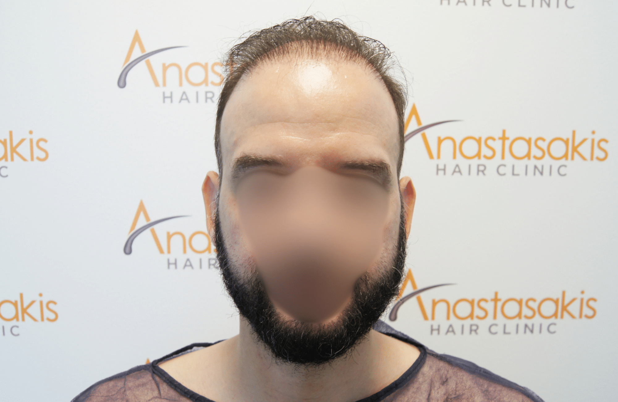 hair transplant result 5500 fus