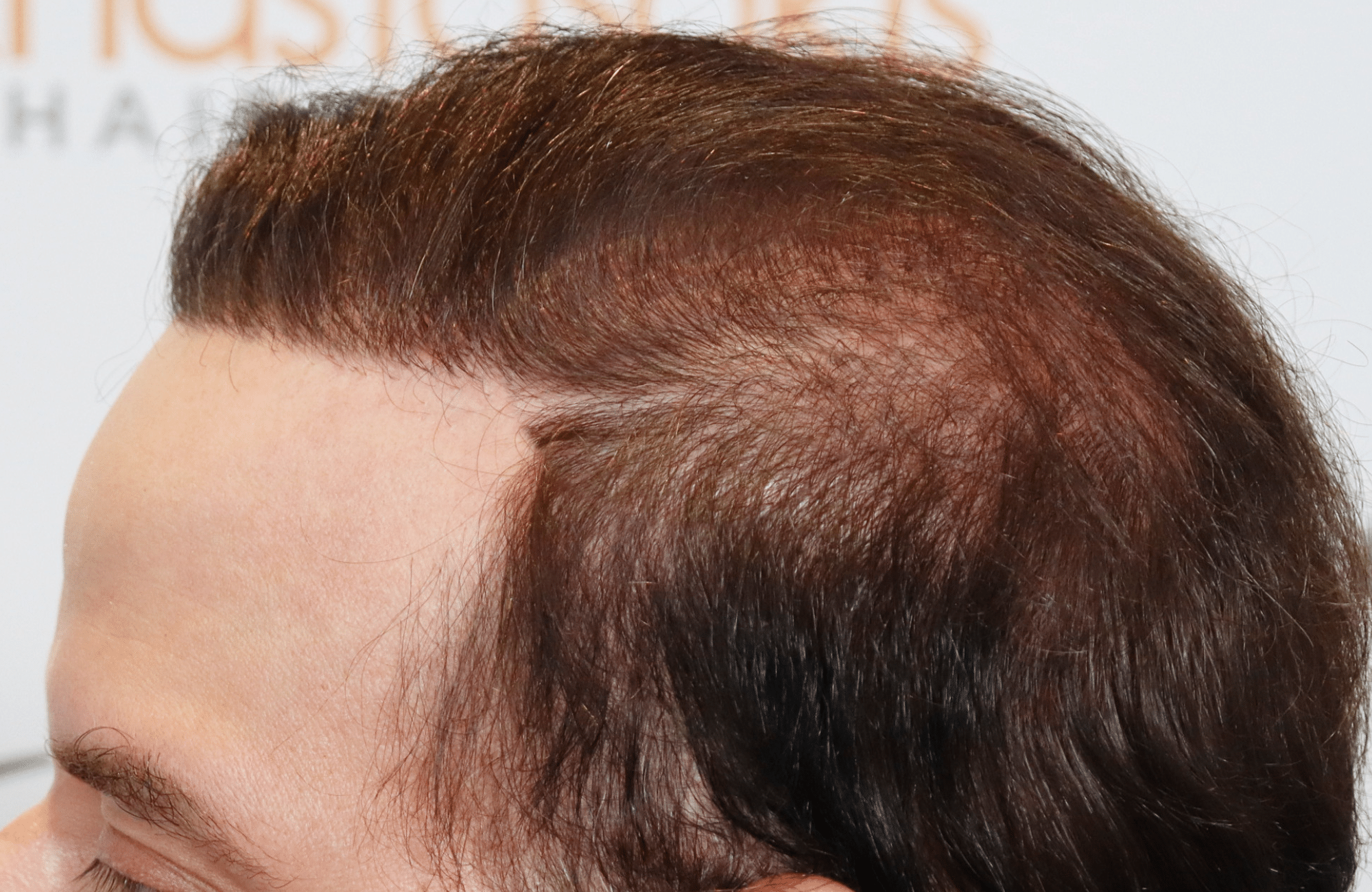hair transplant result 5500 fus