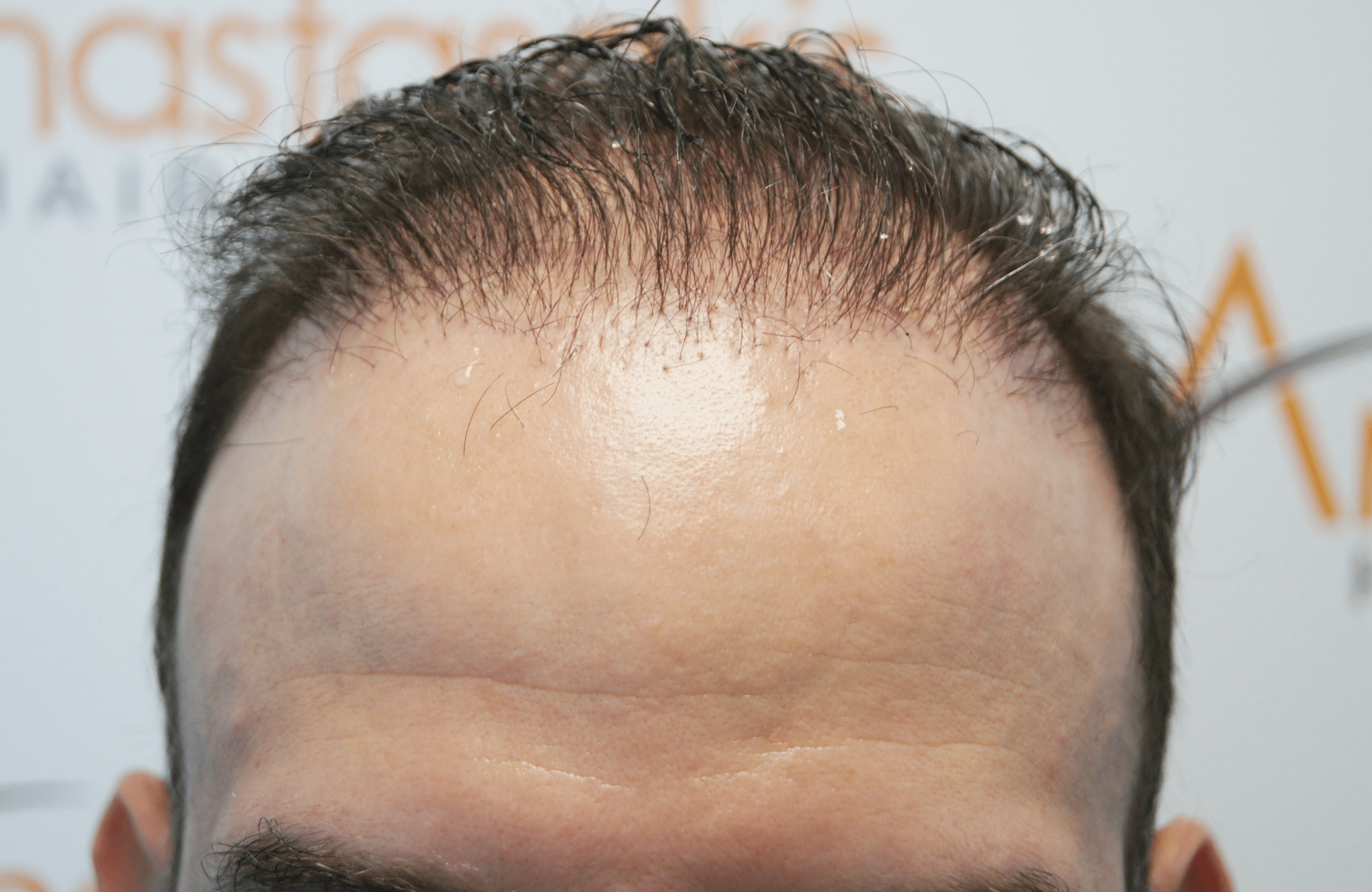 hair transplant result 5500 fus