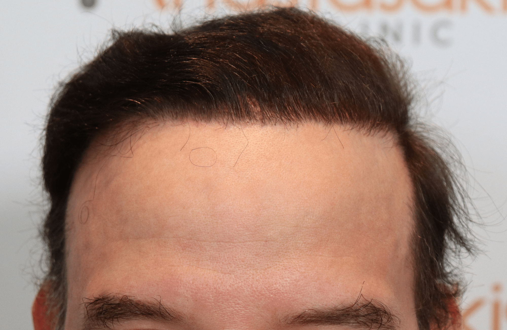 hair transplant result 5500 fus