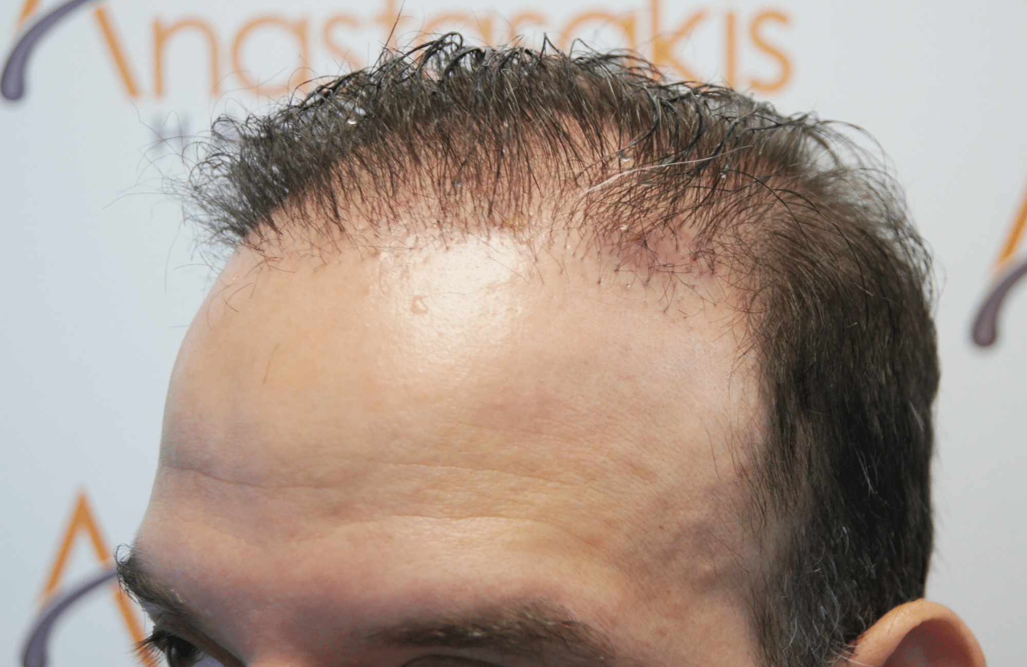 hair transplant result 5500 fus