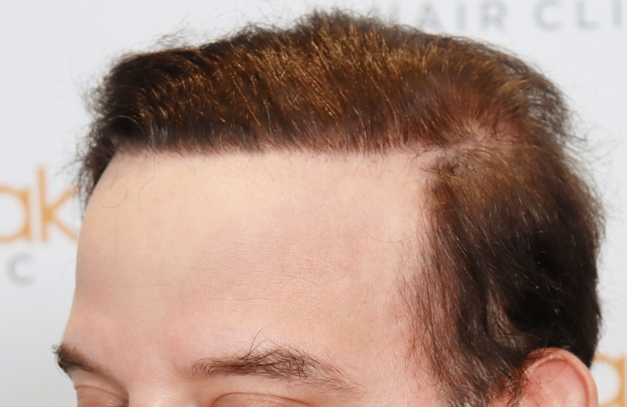 hair transplant result 5500 fus