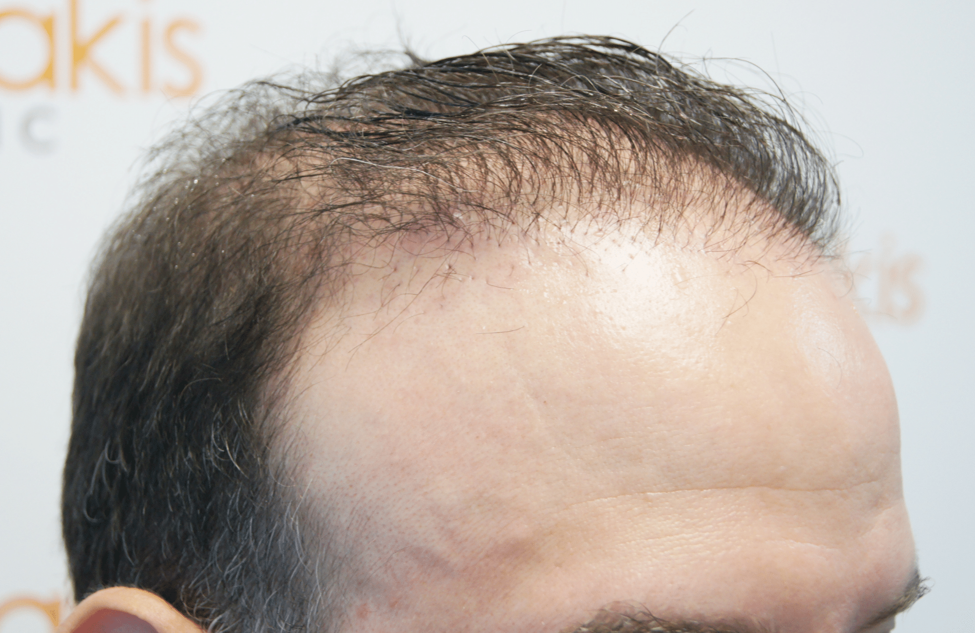 hair transplant result 5500 fus