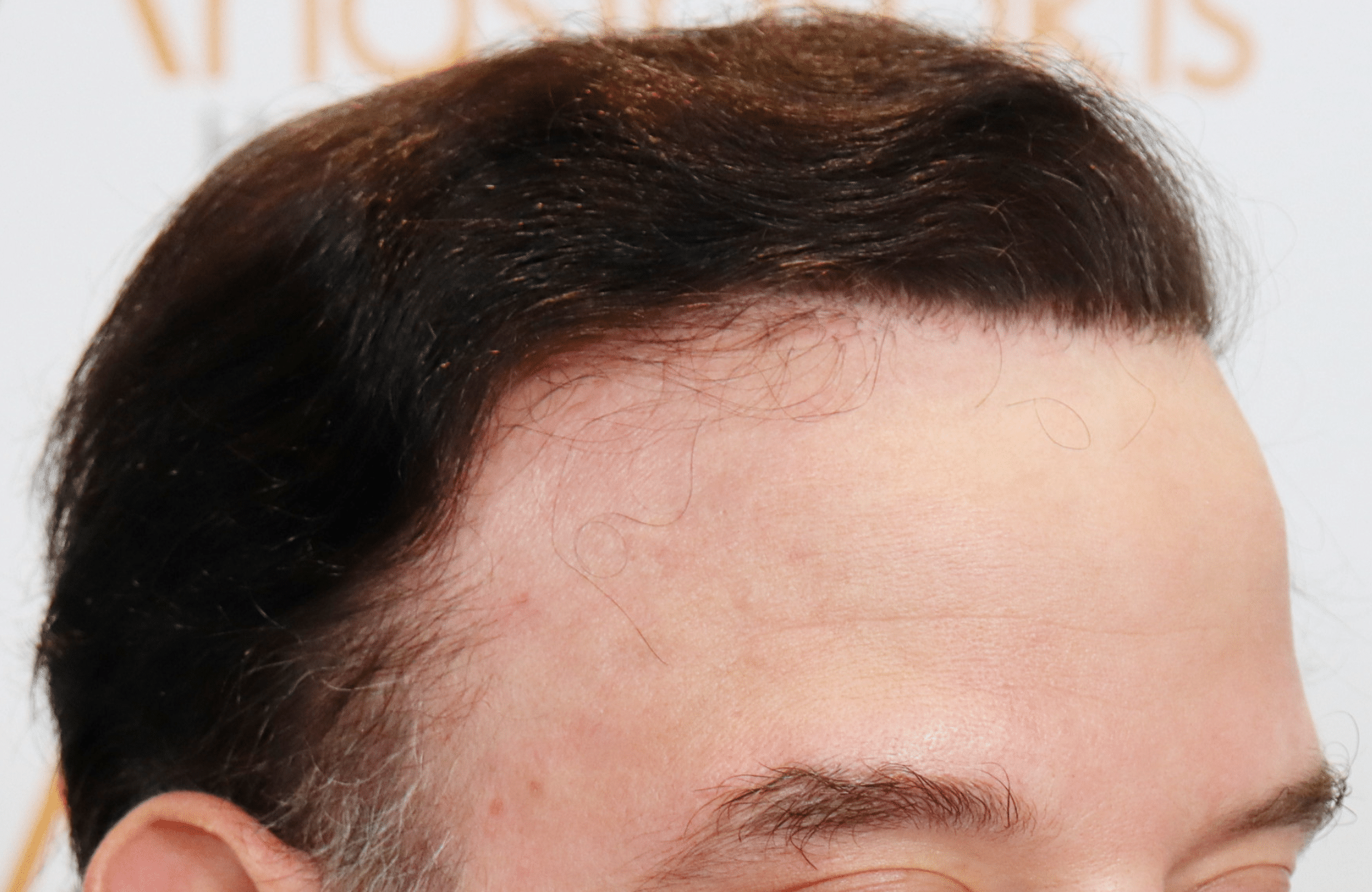 hair transplant result 5500 fus