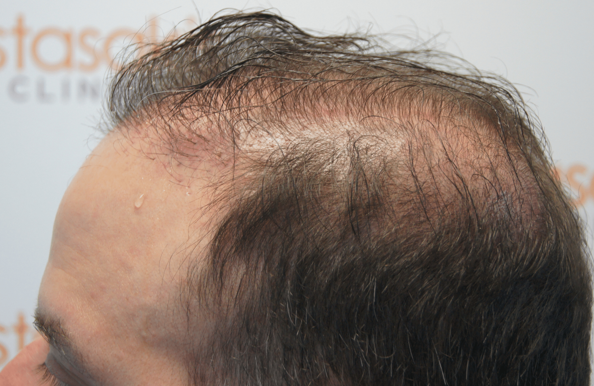 hair transplant result 5500 fus