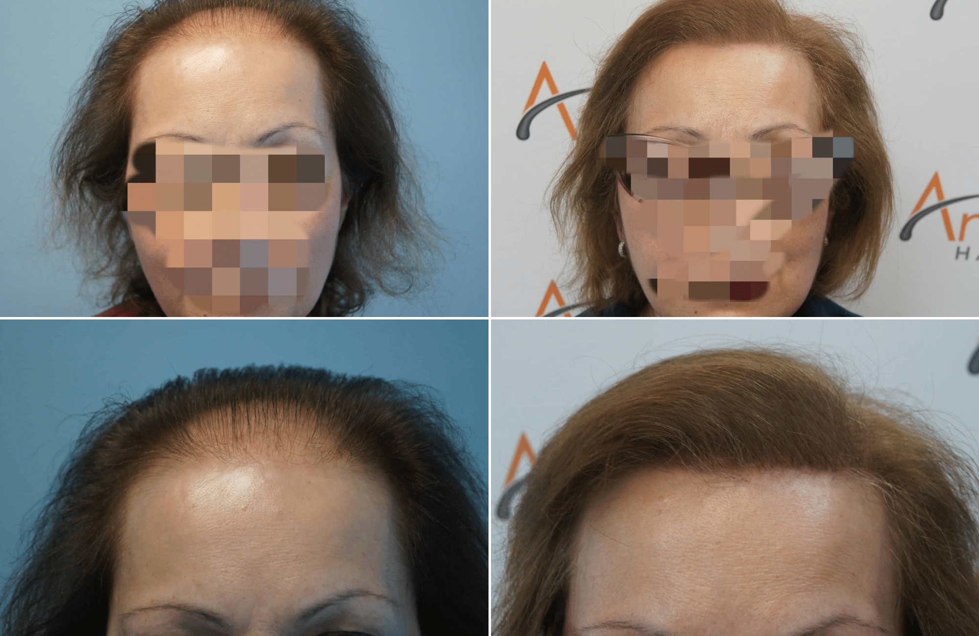 https://anastasakishairclinic.com/portfolio/apotelesma-metamosxefsis-mallion-anastasakis-hair-clinic-270/