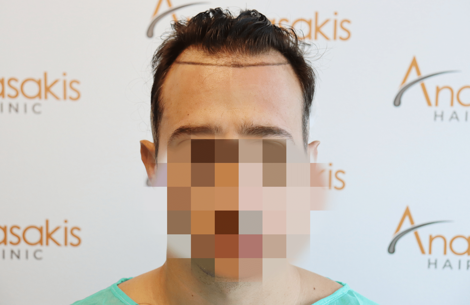 hair transplant result (3)