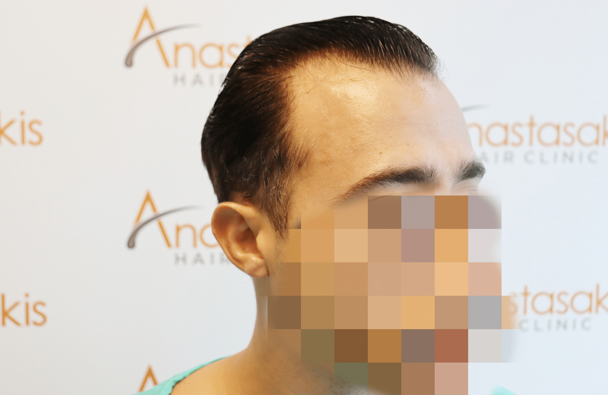 hair transplant result (4)