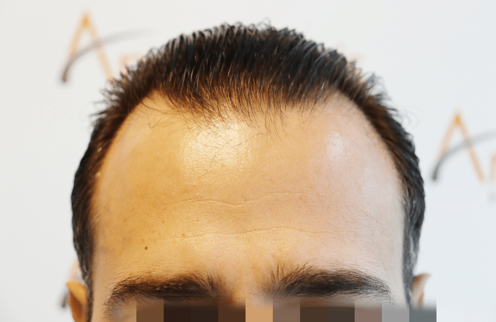 hair transplant result (5)