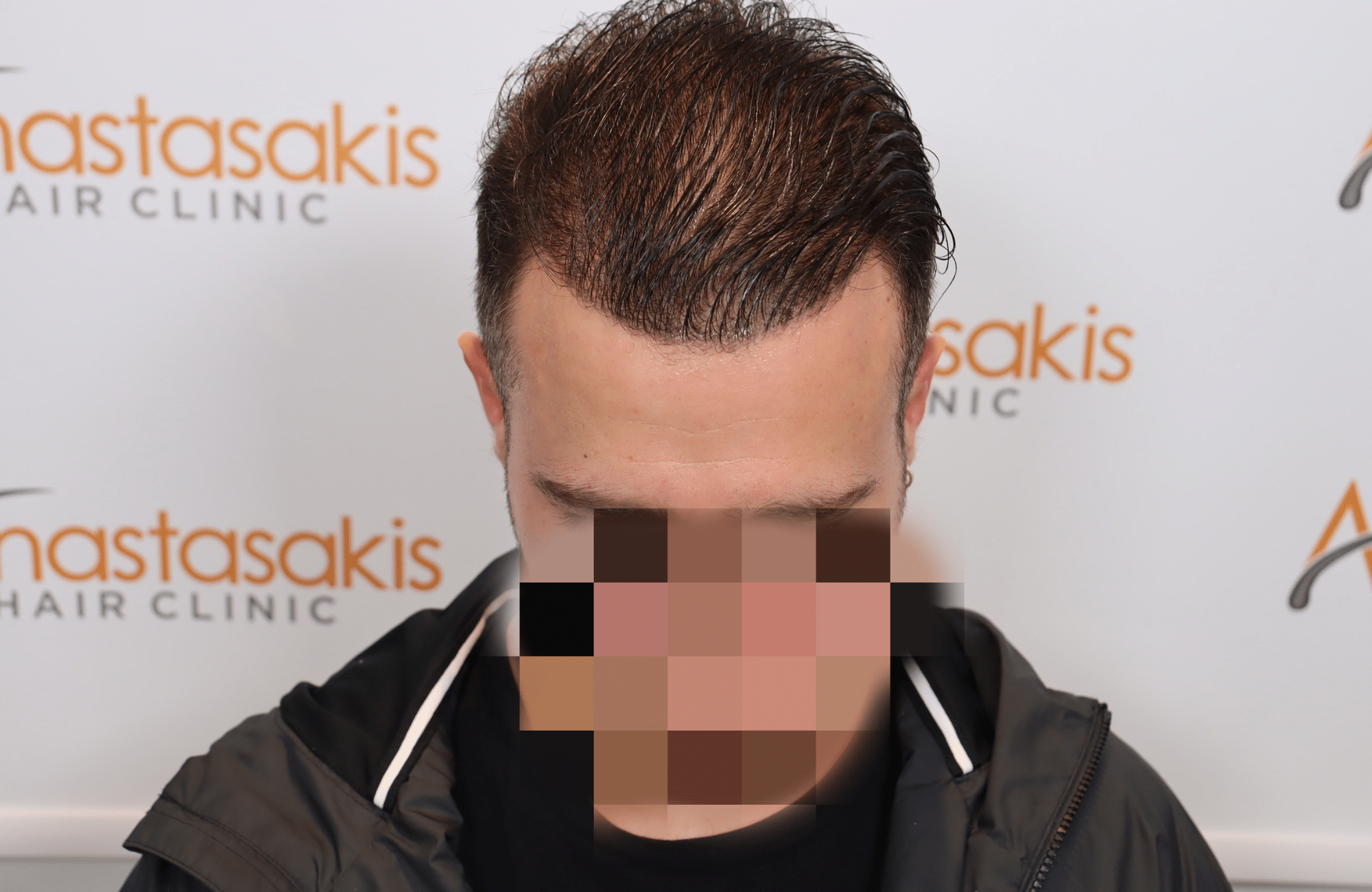 hair transplant result (7)