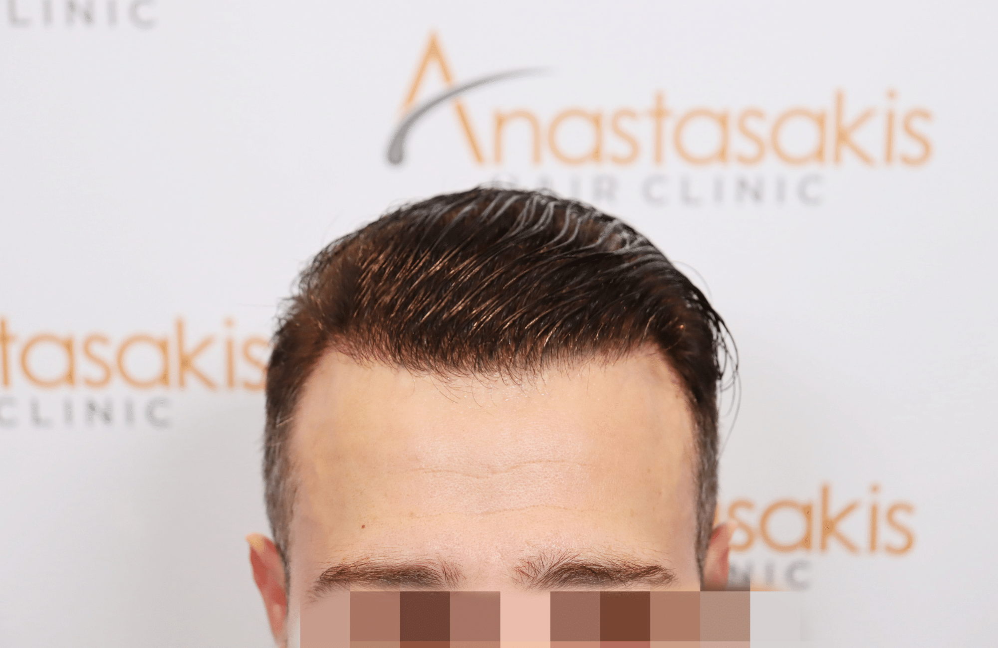 hair transplant result (8)