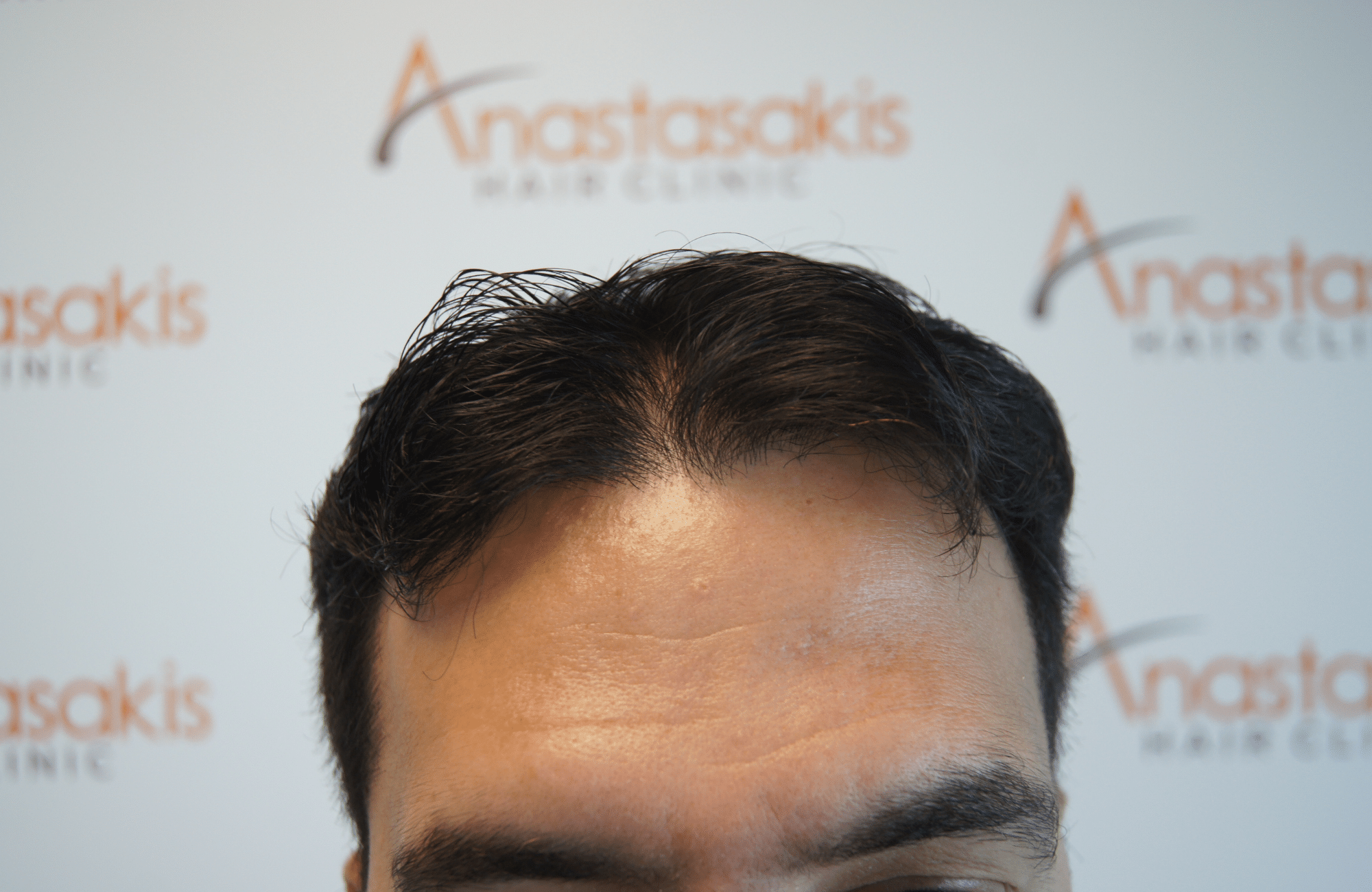 peristatiko prin ti metamosxefsi mallion me 2200 fus hairline