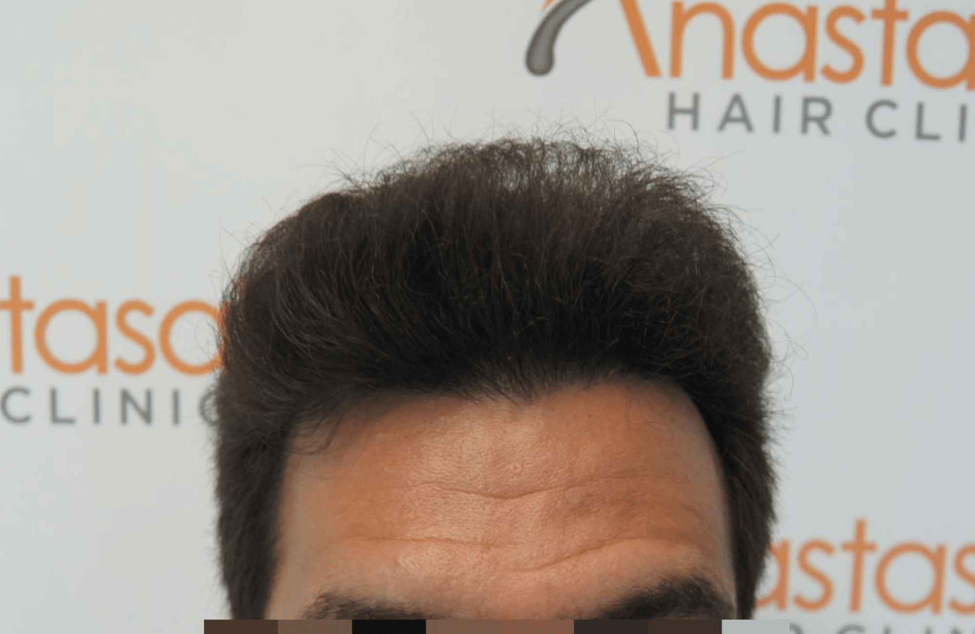 peristatiko meta ti metamosxefsi mallion me 2200 fus hairline