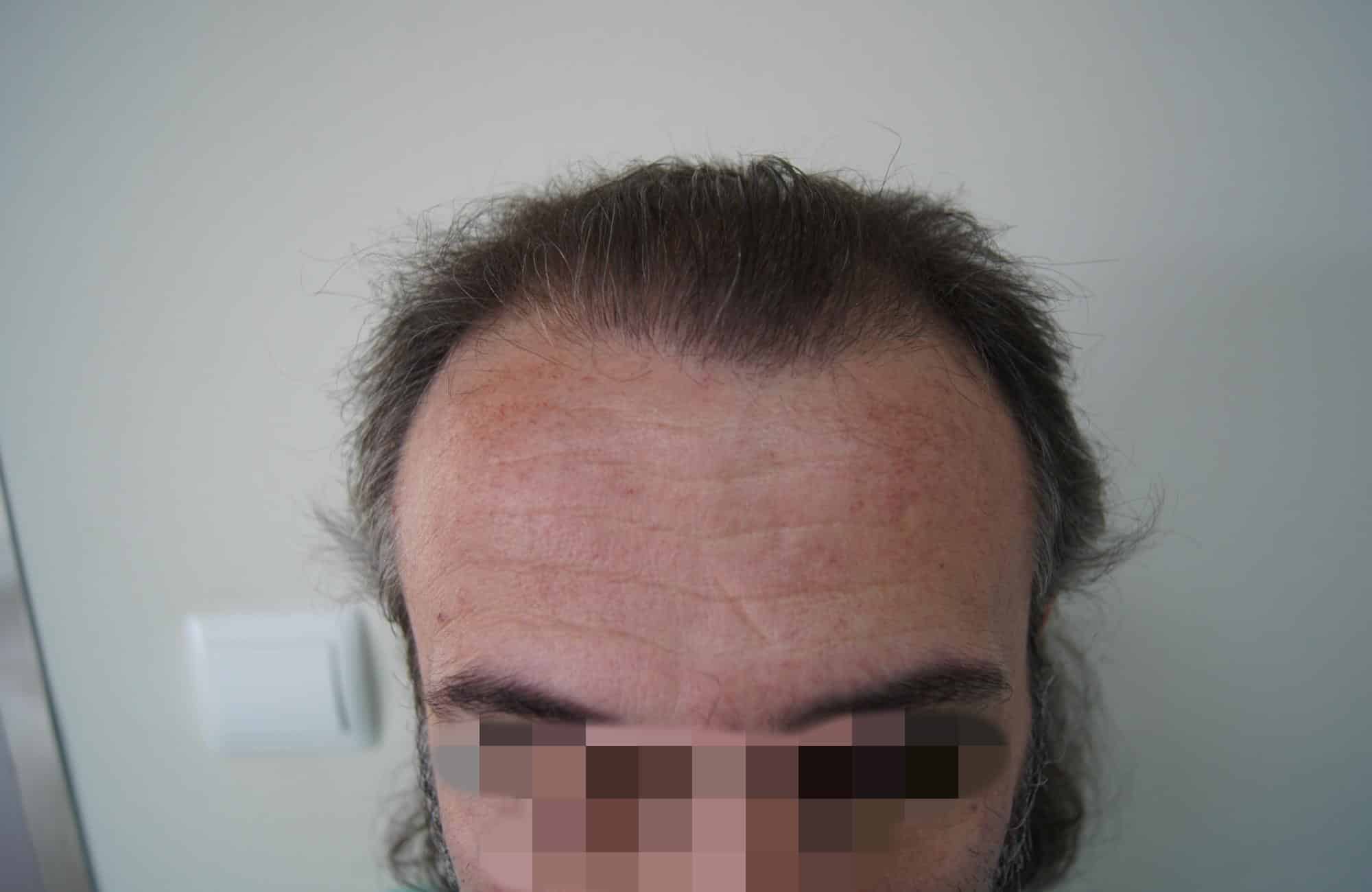 μεταμοσχευση μαλλιων πριν και μετα