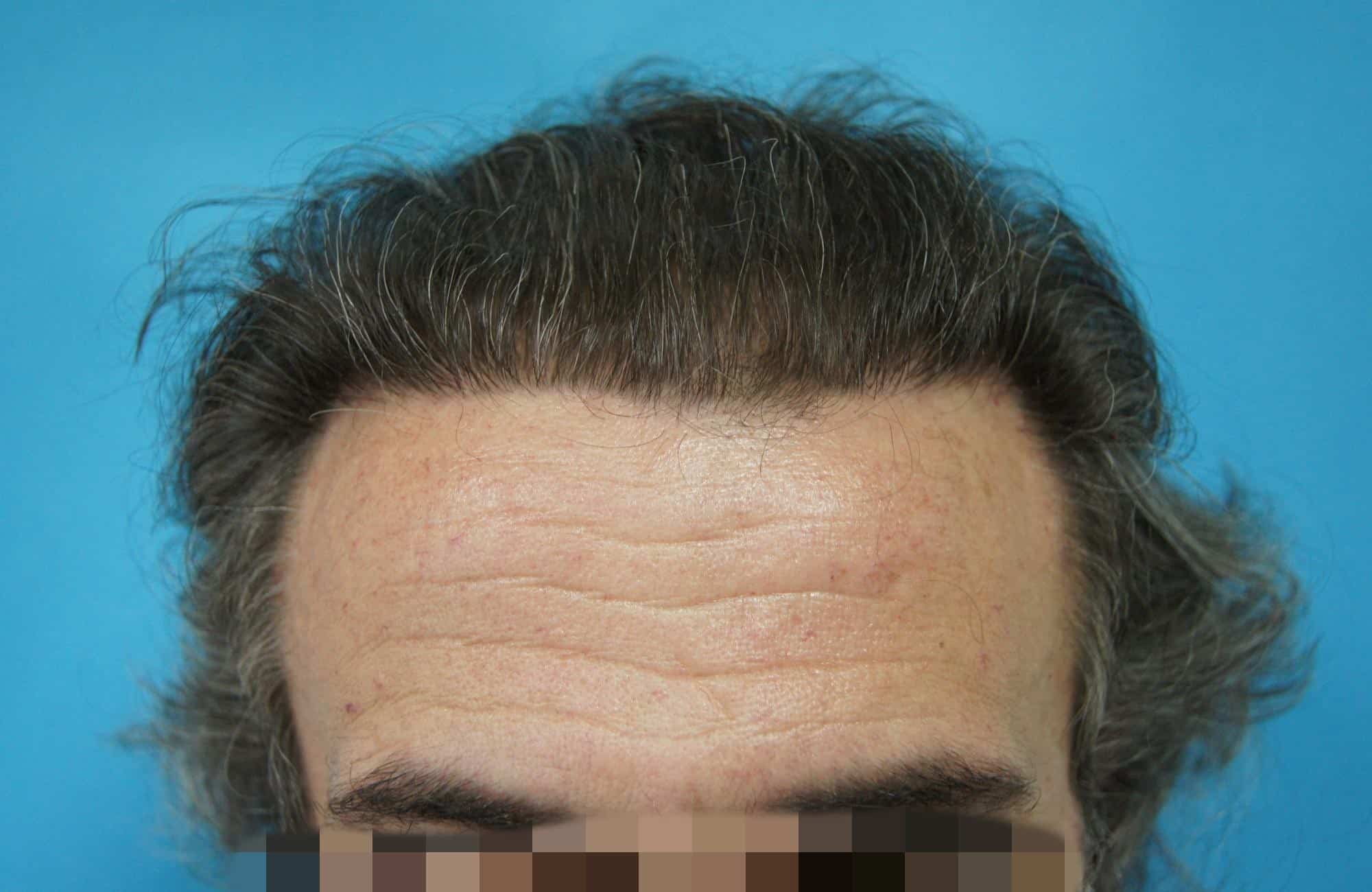 μεταμοσχευση μαλλιων πριν και μετα