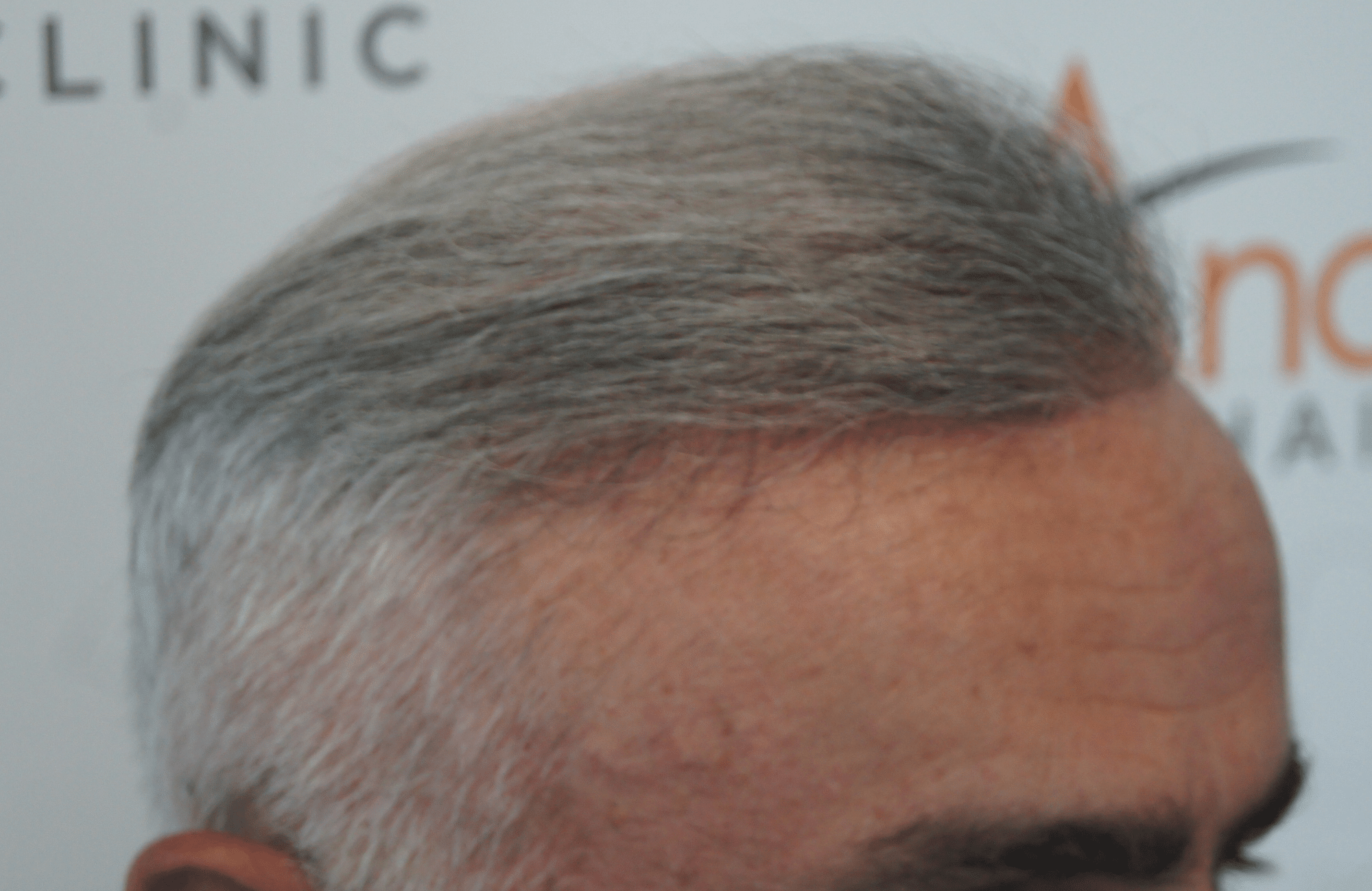 hair transplant result with 2500 follicular units anastasakis hair clinic