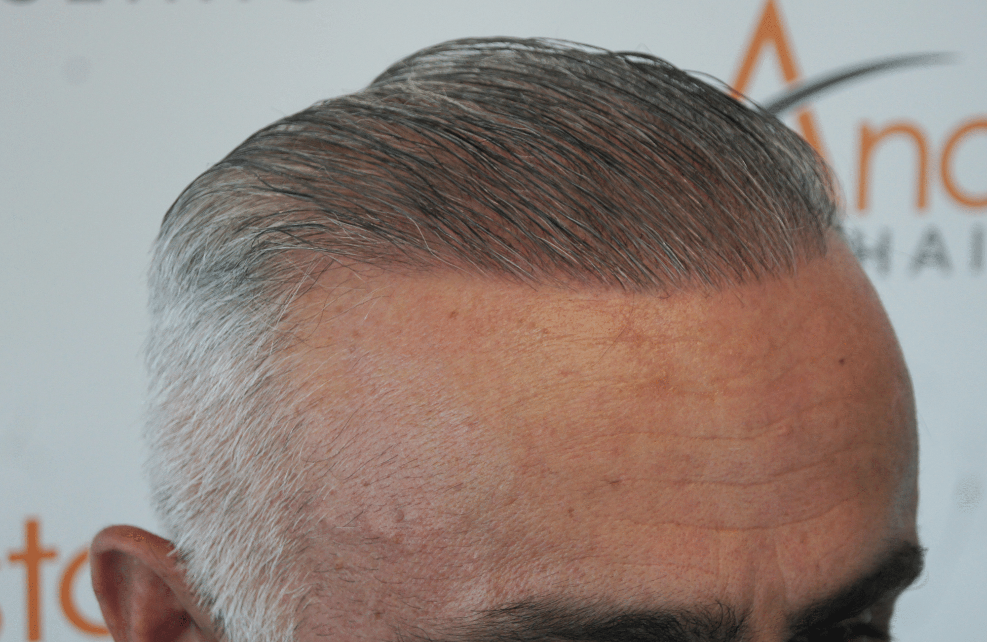 hair transplant result with 2500 follicular units anastasakis hair clinic
