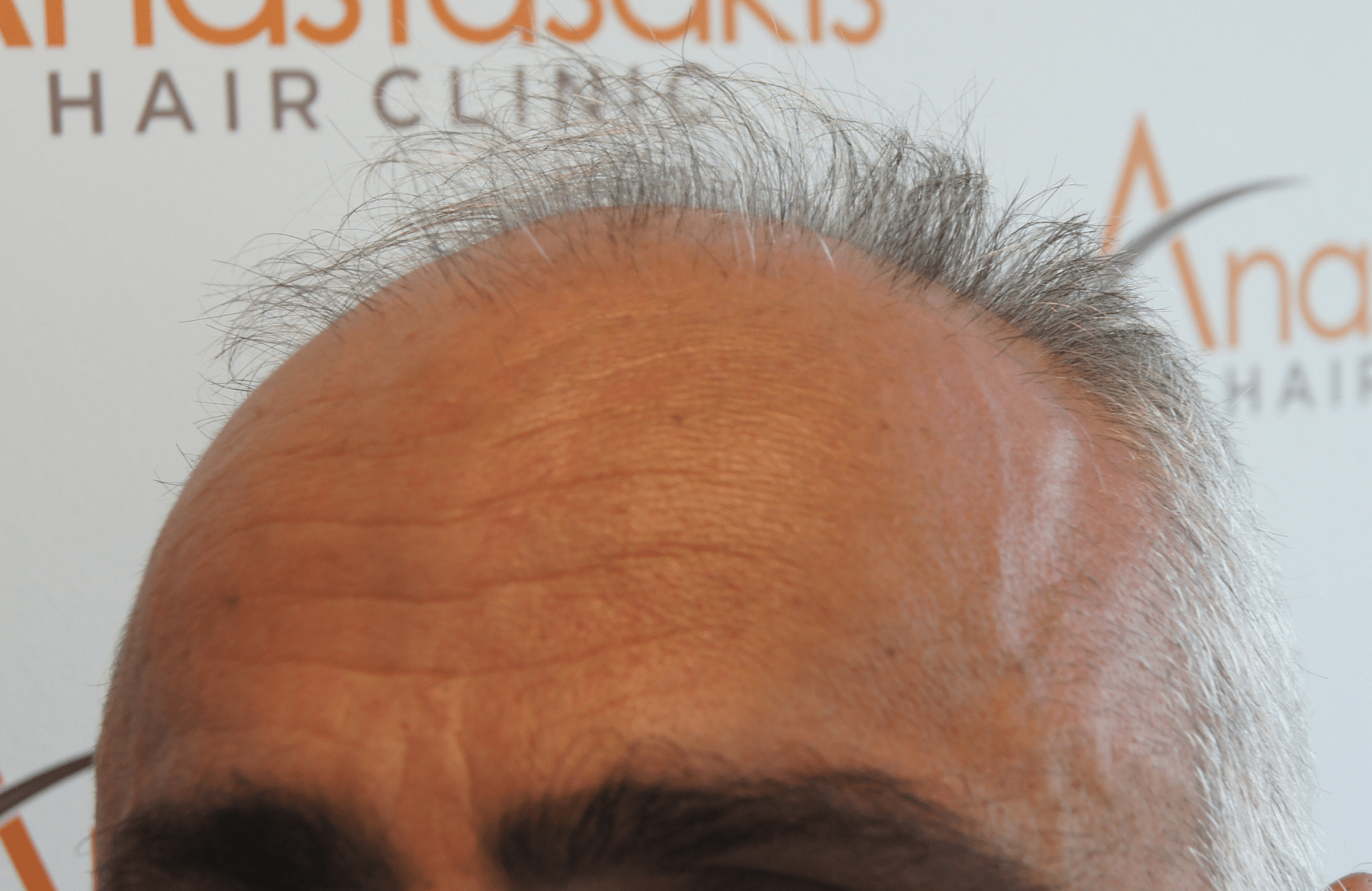 hair transplant result with 2500 follicular units anastasakis hair clinic