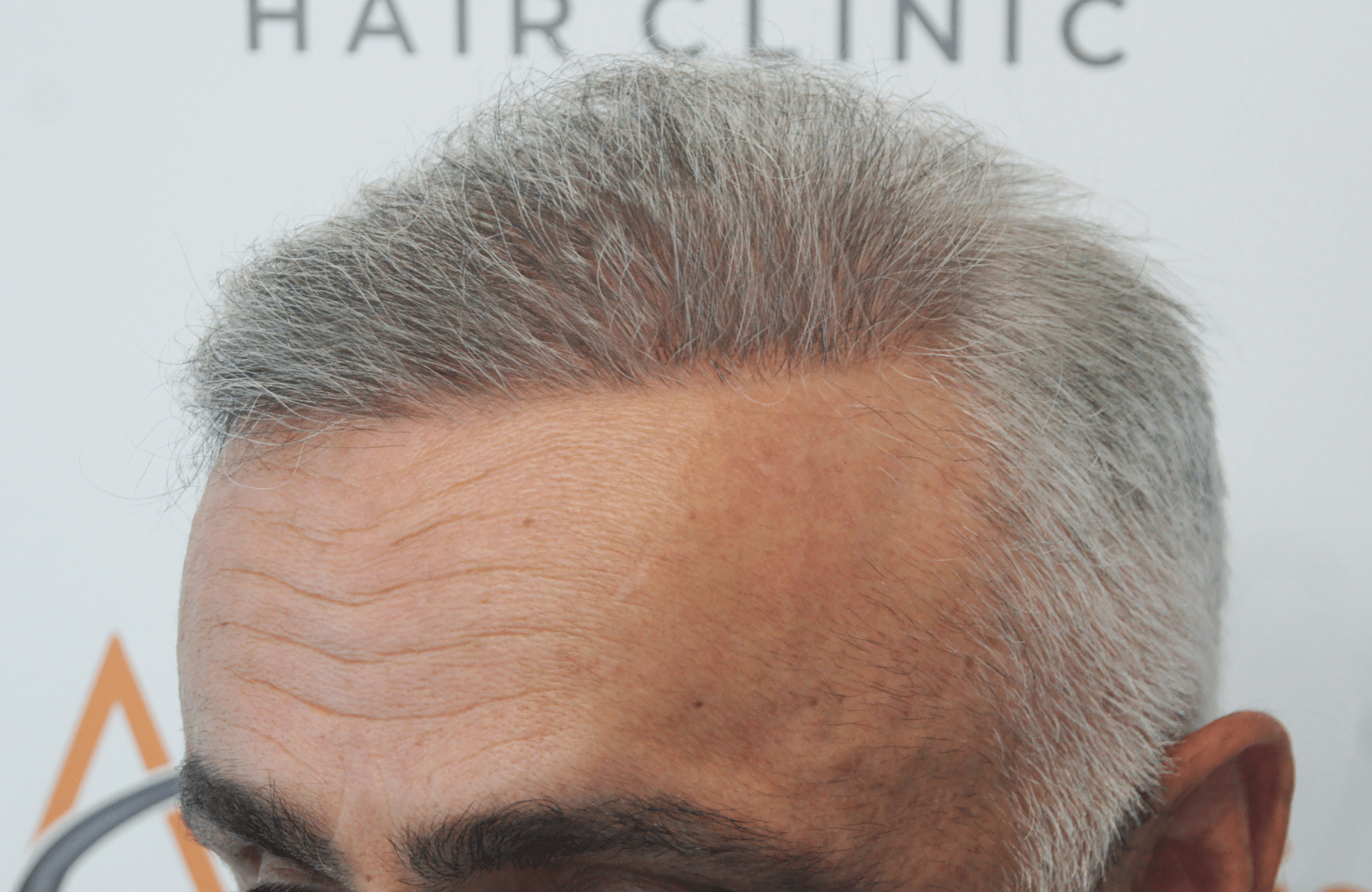hair transplant result with 2500 follicular units anastasakis hair clinic
