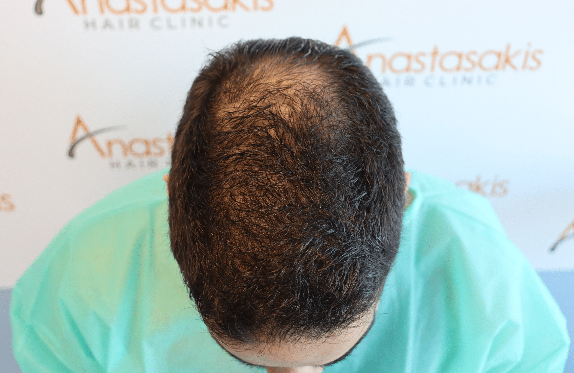 Hair Transplant Result 2300 fus frontal thick (4)