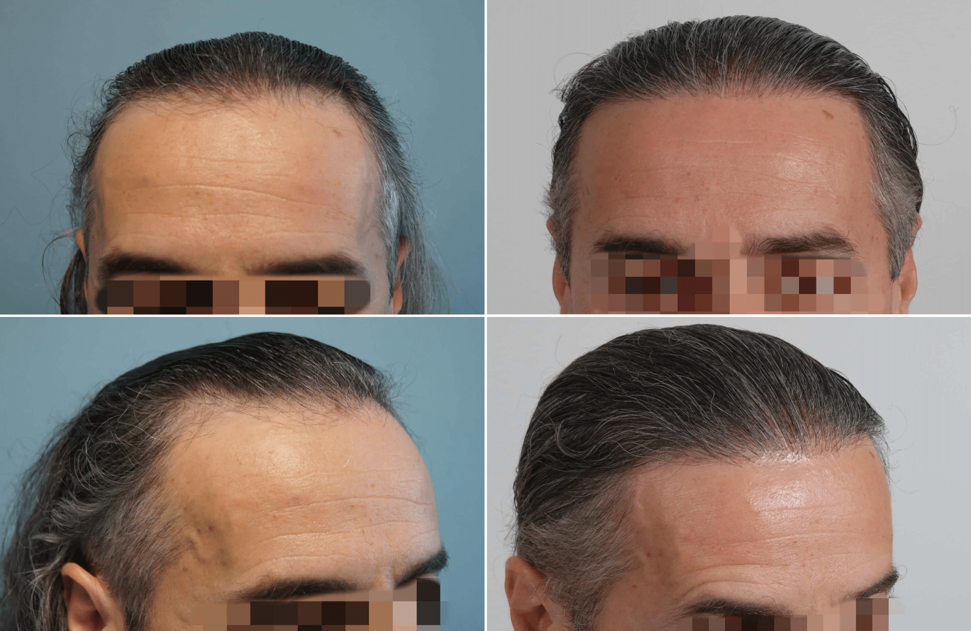 https://anastasakishairclinic.com/portfolio/apotelesma-metamosxefsis-mallion-anastasakis-hair-clinic-151/