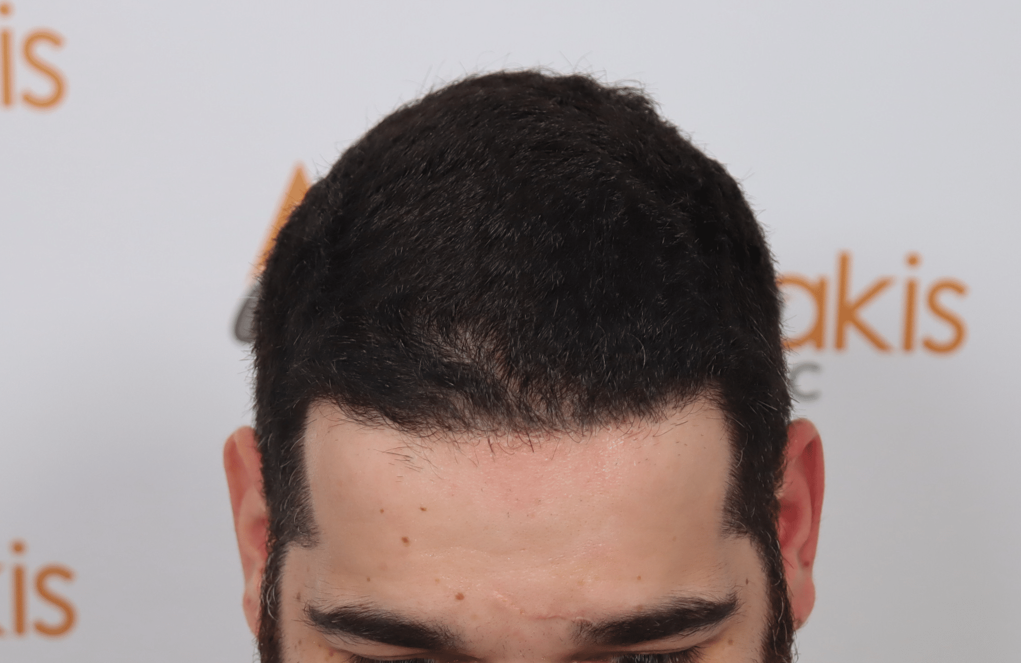 Hair Transplant Result 2300 fus frontal thick (4)