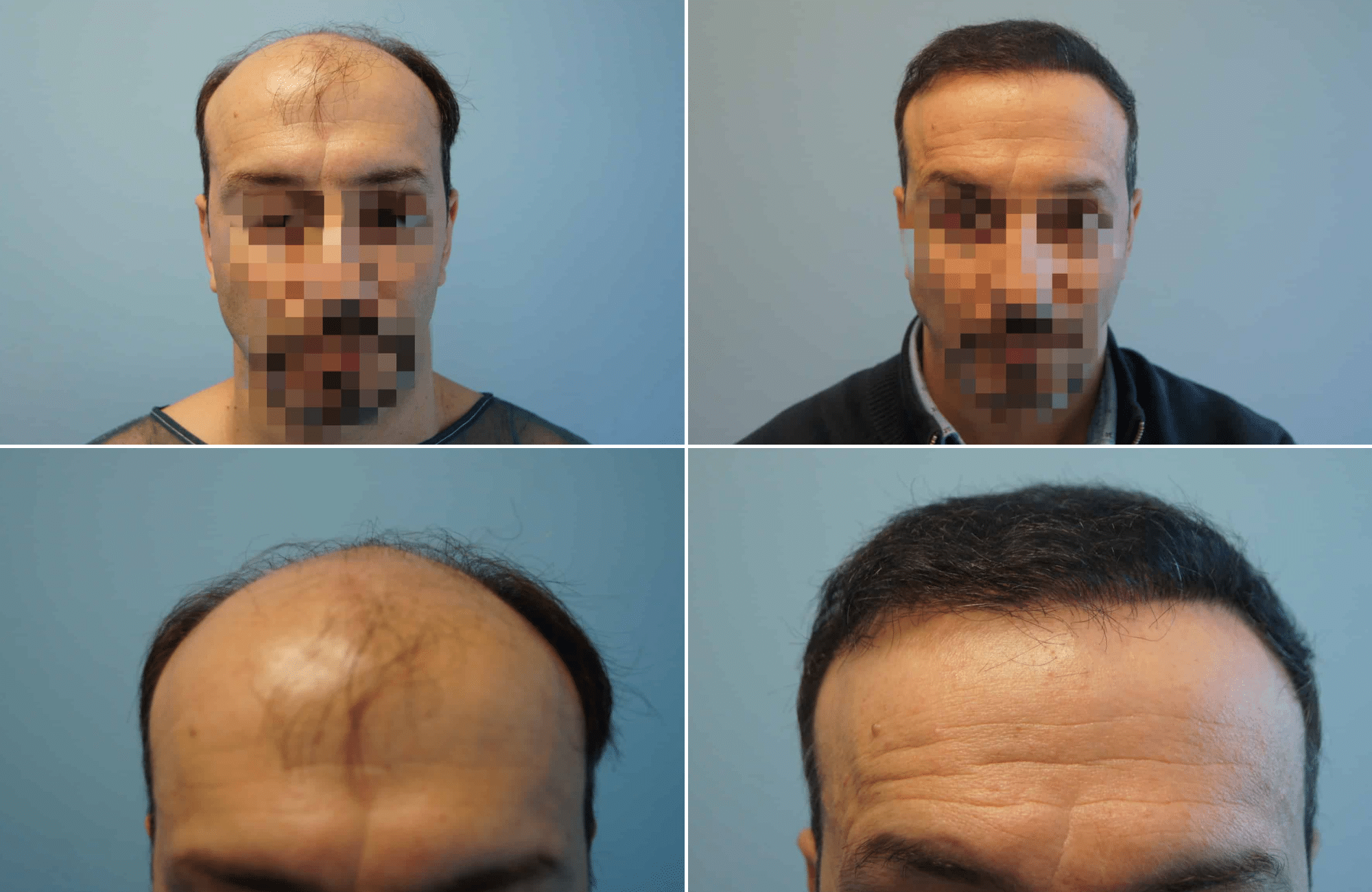 https://anastasakishairclinic.com/portfolio/apotelesma-metamosxefsis-mallion-anastasakis-hair-clinic-18/
