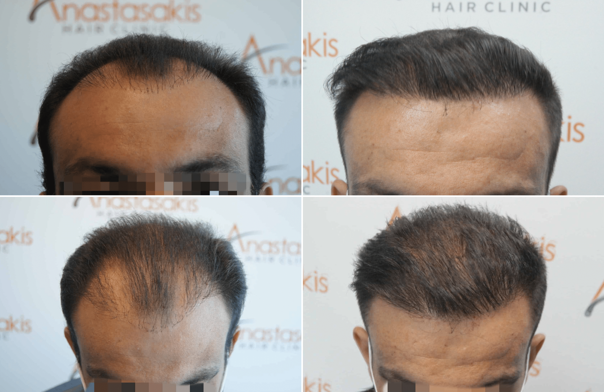 https://anastasakishairclinic.com/portfolio/apotelesma-metamosxefsis-mallion-anastasakis-hair-clinic-197/