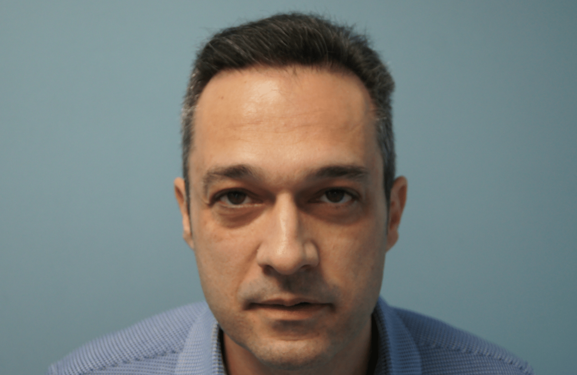 φυσικό αποτελεσμα πυκνωσης στη μεταμόσχευση μαλλιων στην anastasakis hair clinic με fue και fut combo