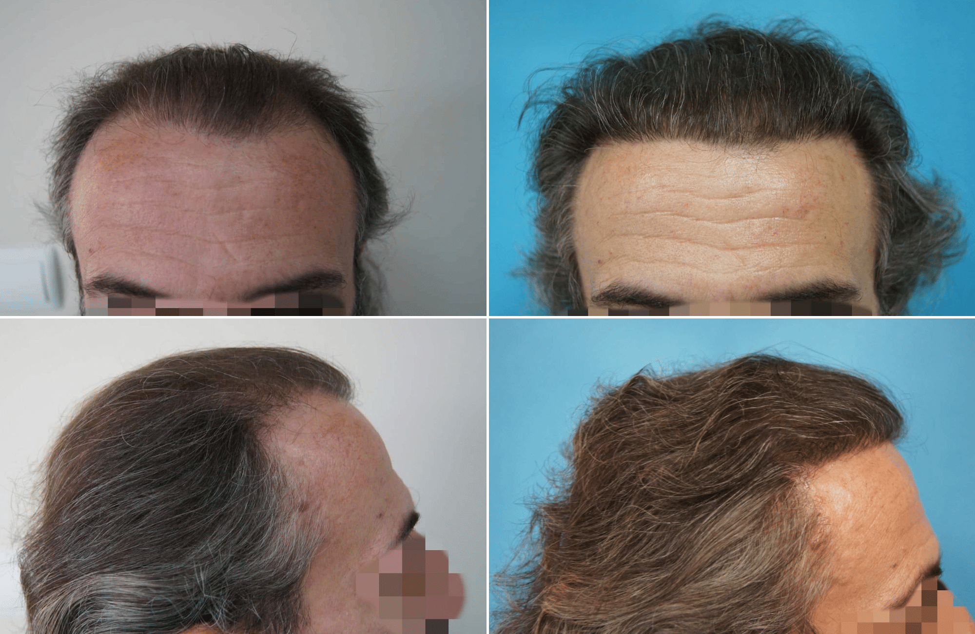 https://anastasakishairclinic.com/portfolio/apotelesma-metamosxefsis-mallion-anastasakis-hair-clinic-200/