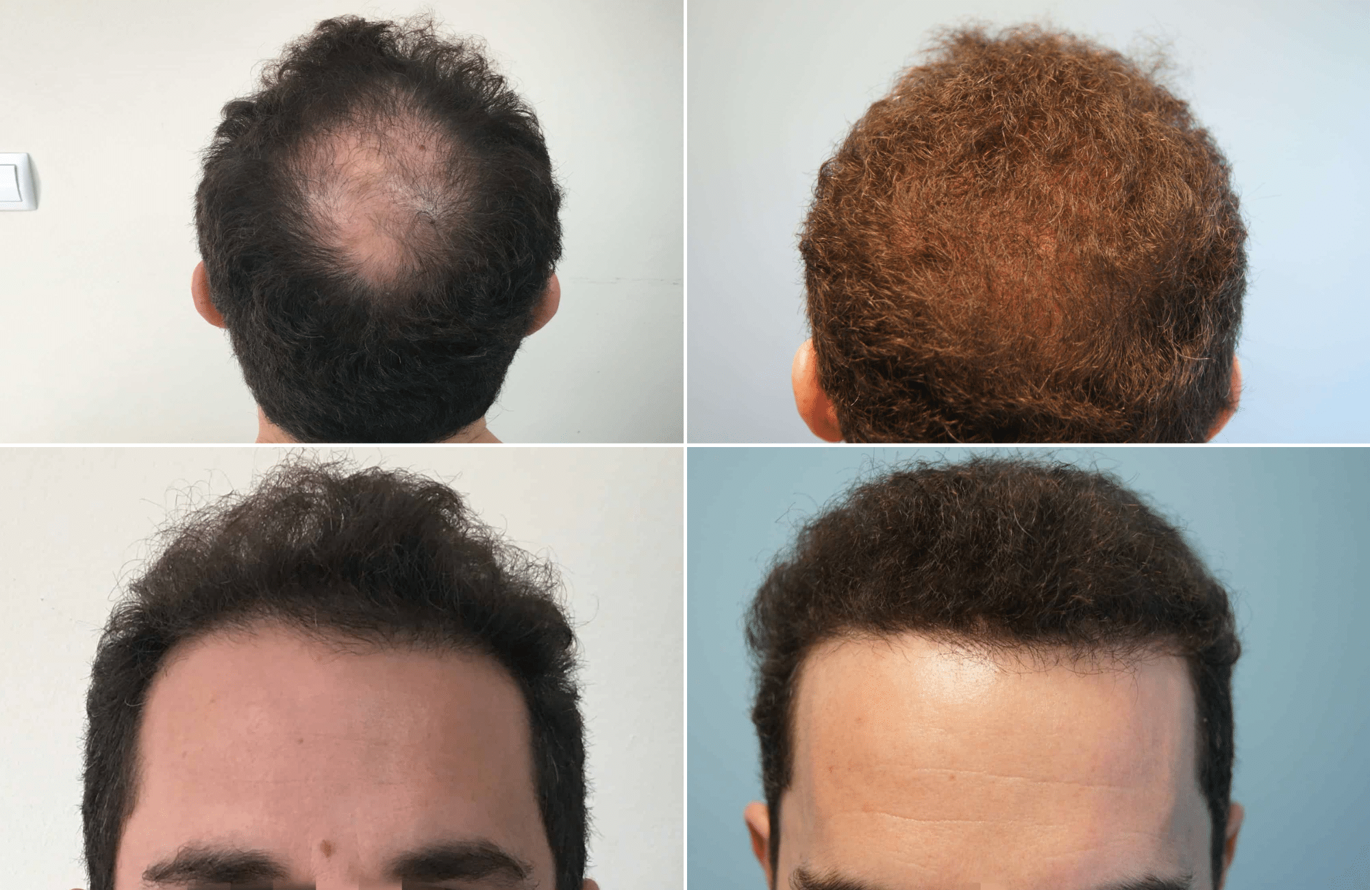 https://anastasakishairclinic.com/portfolio/apotelesma-metamosxefsis-mallion-anastasakis-hair-clinic-144/
